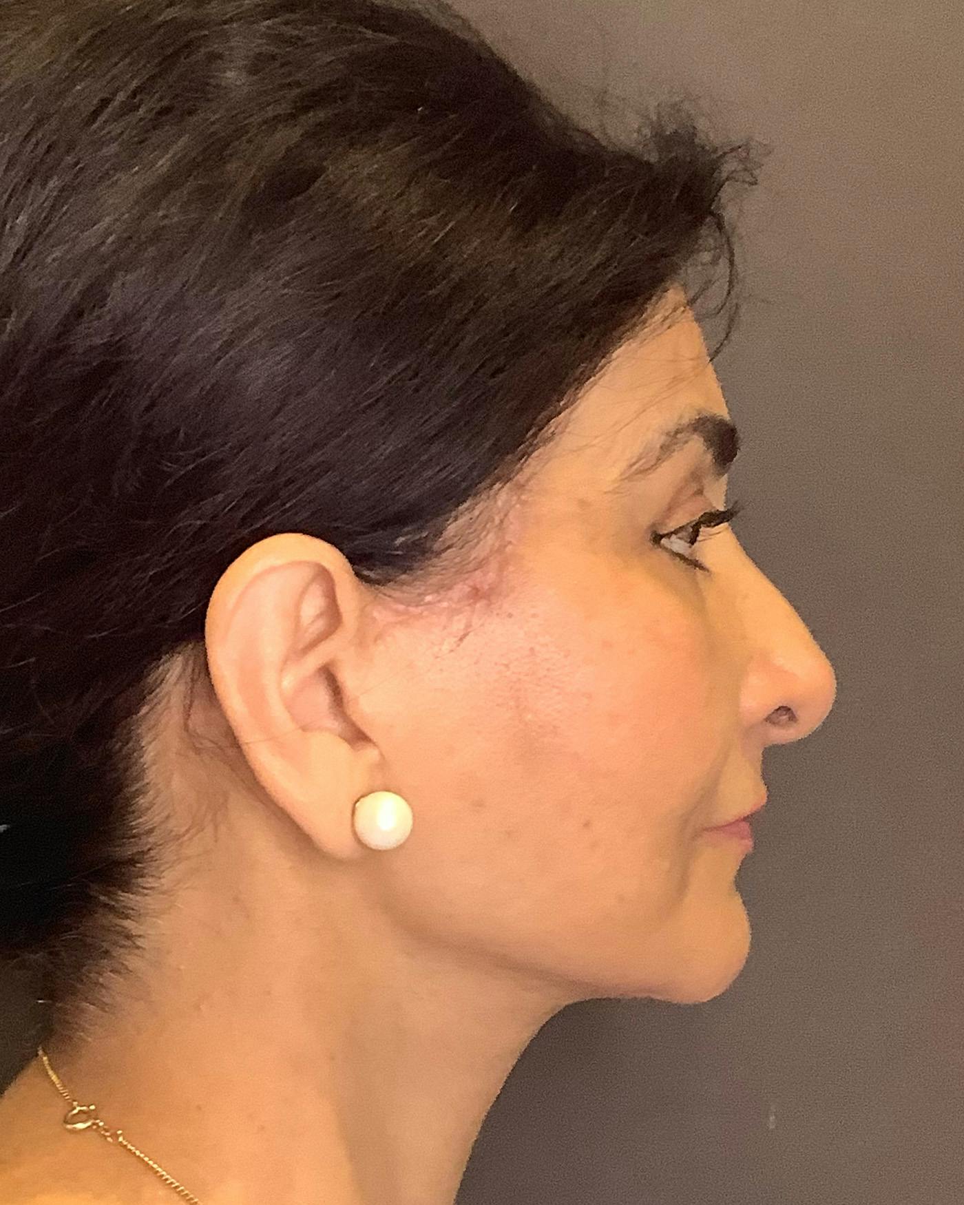Facelifts / Necklift Before & After Gallery - Patient 190626 - Image 8