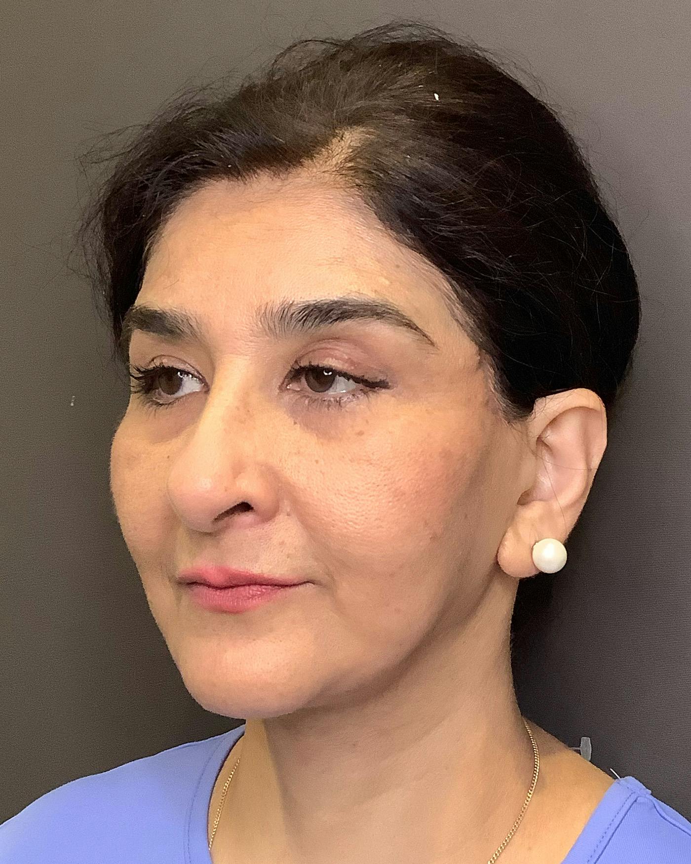 Facelifts / Necklift Before & After Gallery - Patient 190626 - Image 6