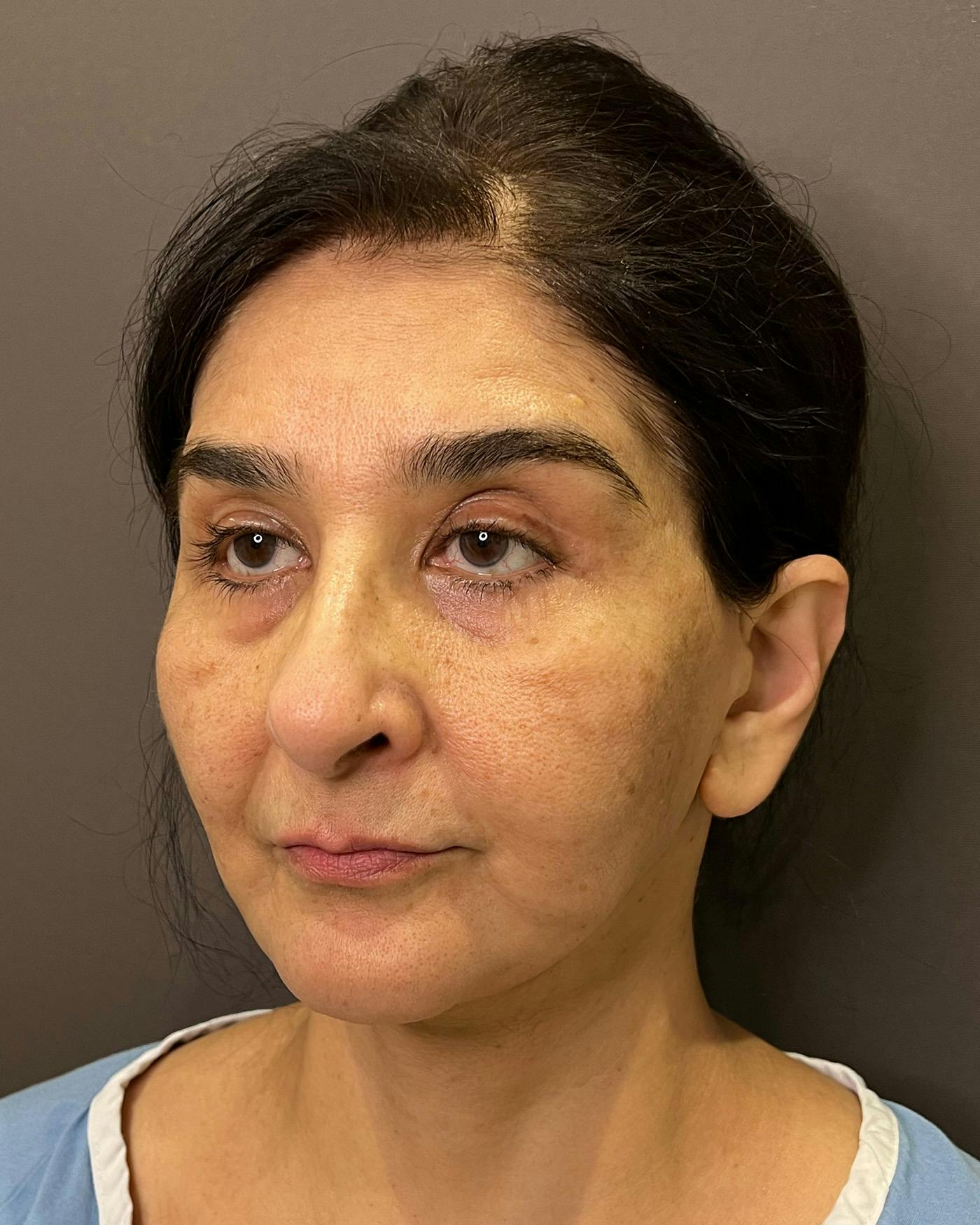 Facelifts / Necklift Before & After Gallery - Patient 190626 - Image 5