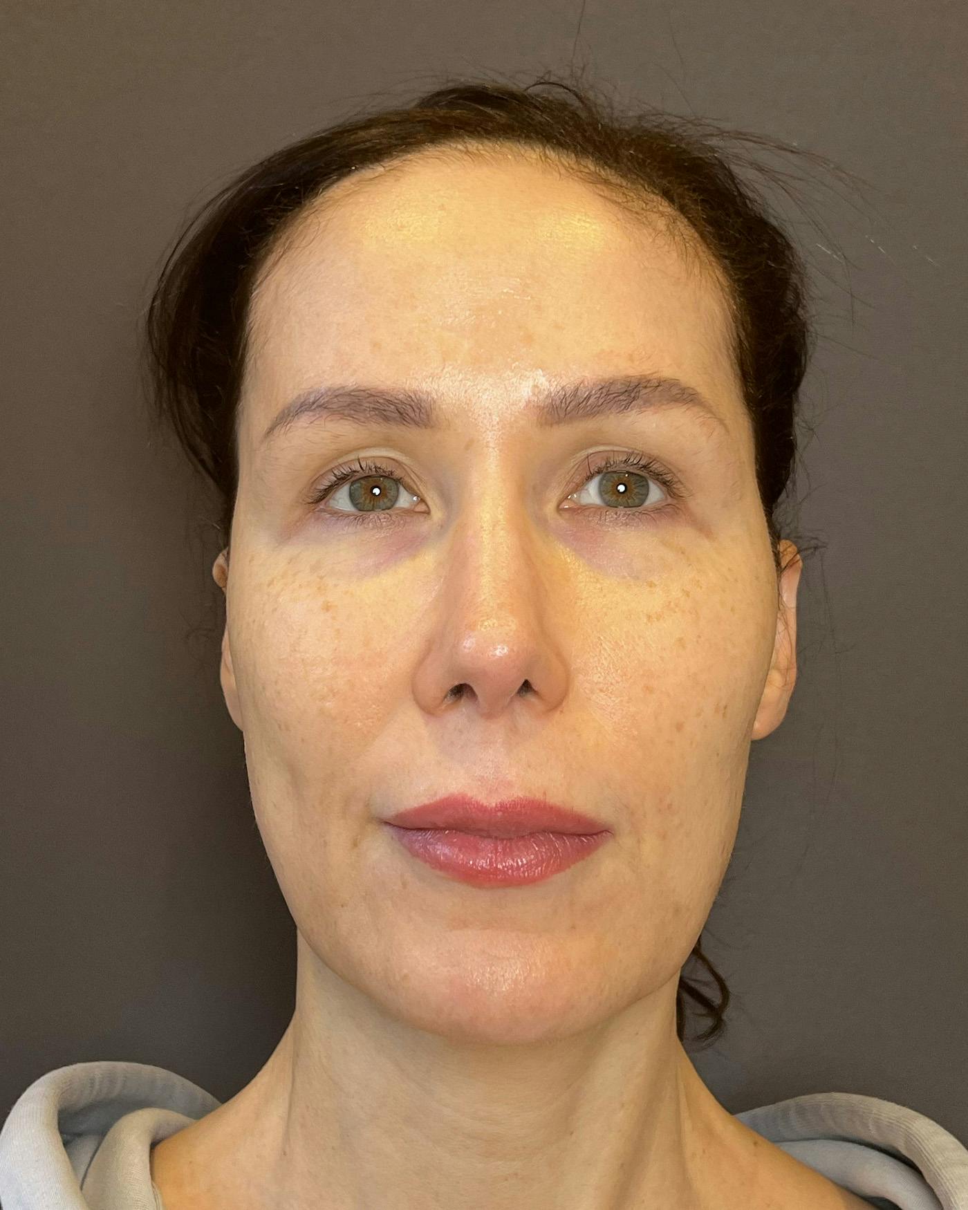 Facelifts / Necklift Before & After Gallery - Patient 159877 - Image 4