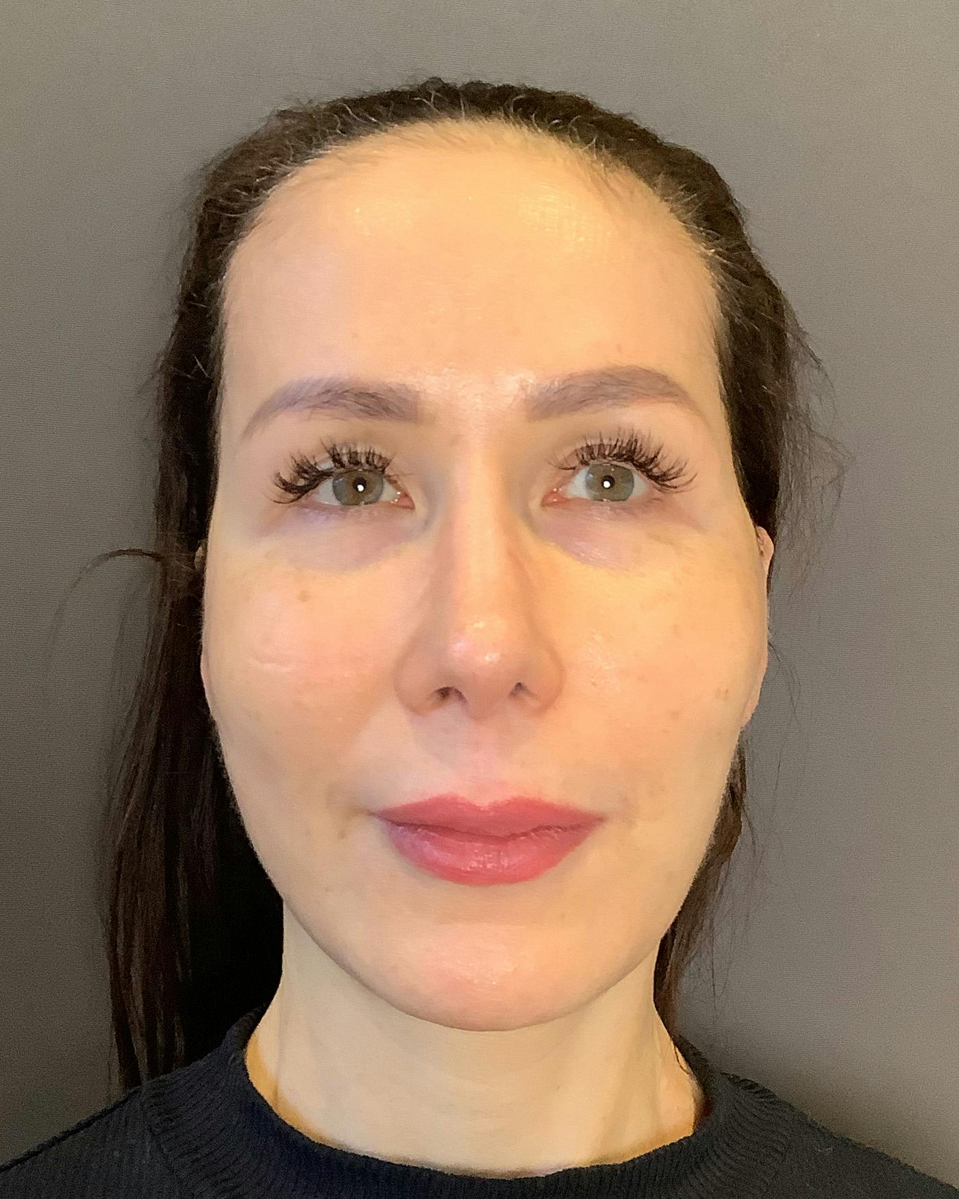 Facelifts / Necklift Before & After Gallery - Patient 159877 - Image 5