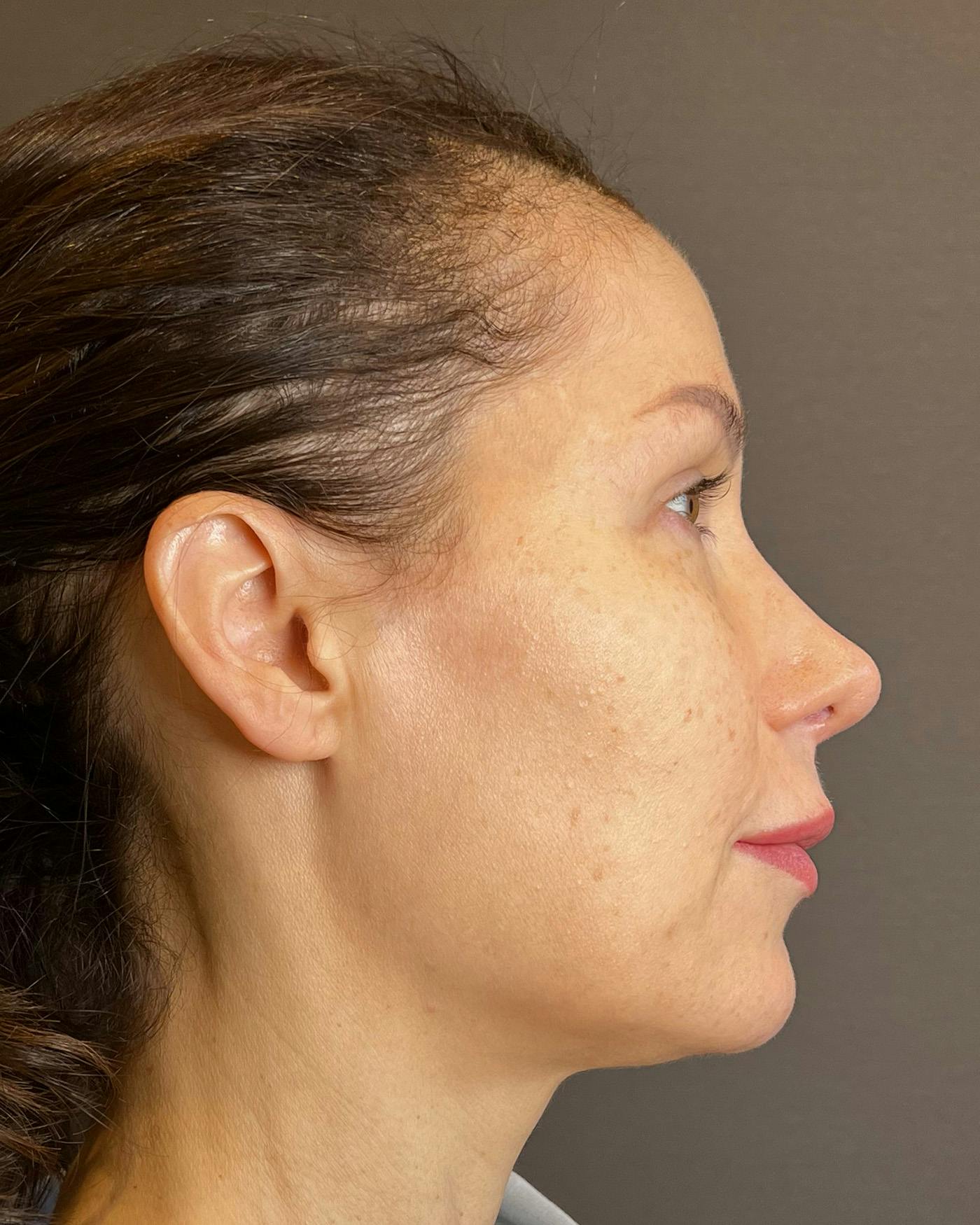 Facelifts / Necklift Before & After Gallery - Patient 159877 - Image 3
