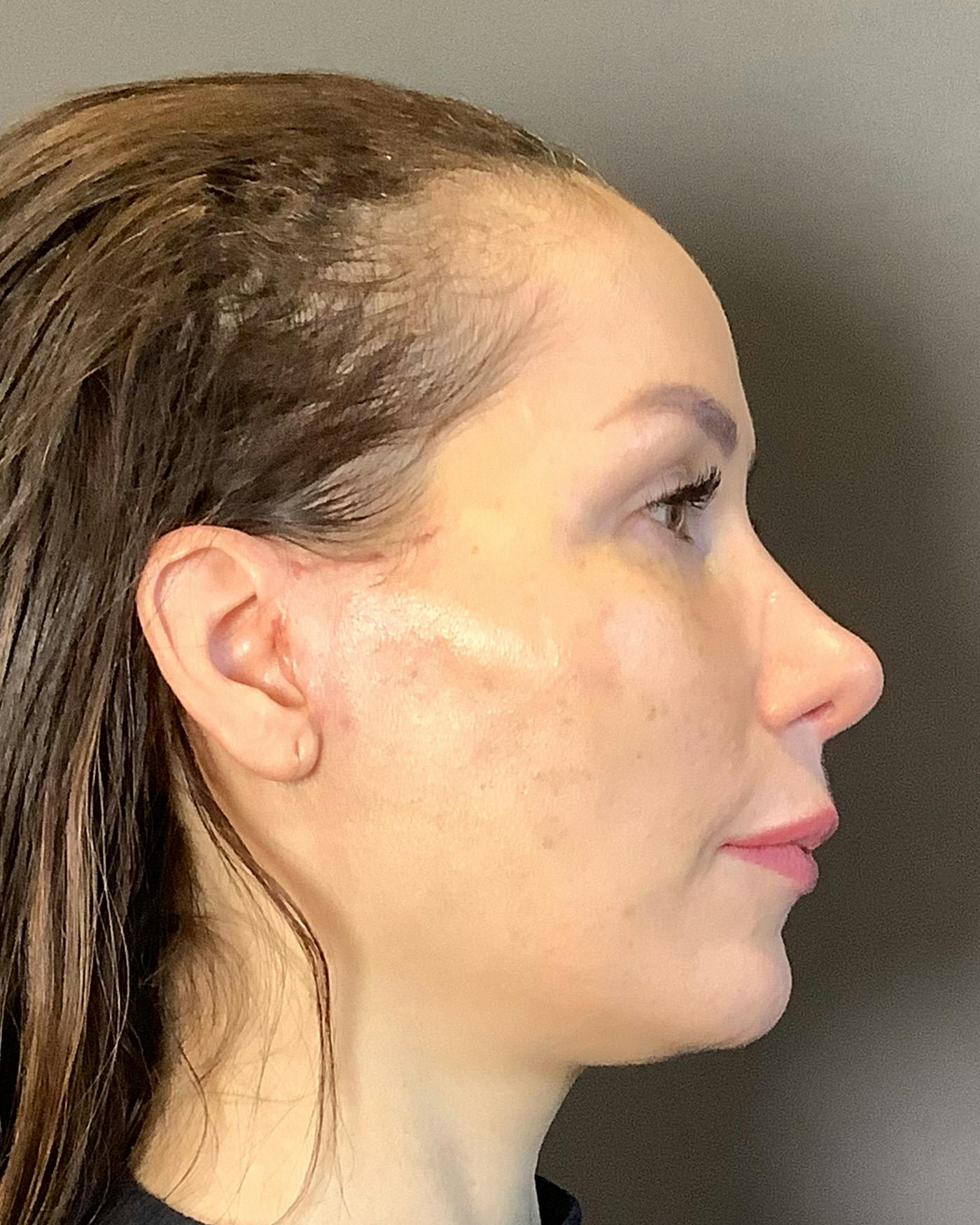 Facelifts / Necklift Before & After Gallery - Patient 159877 - Image 6