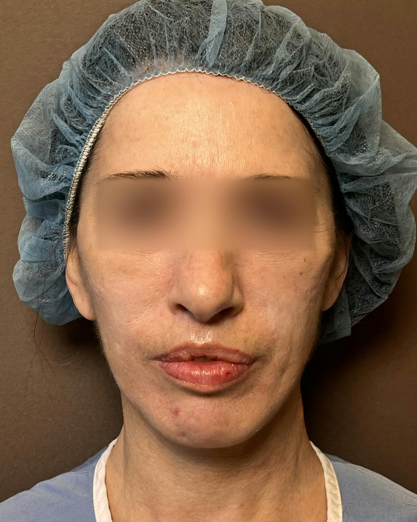 Facelifts / Necklift Before & After Gallery - Patient 842301 - Image 3