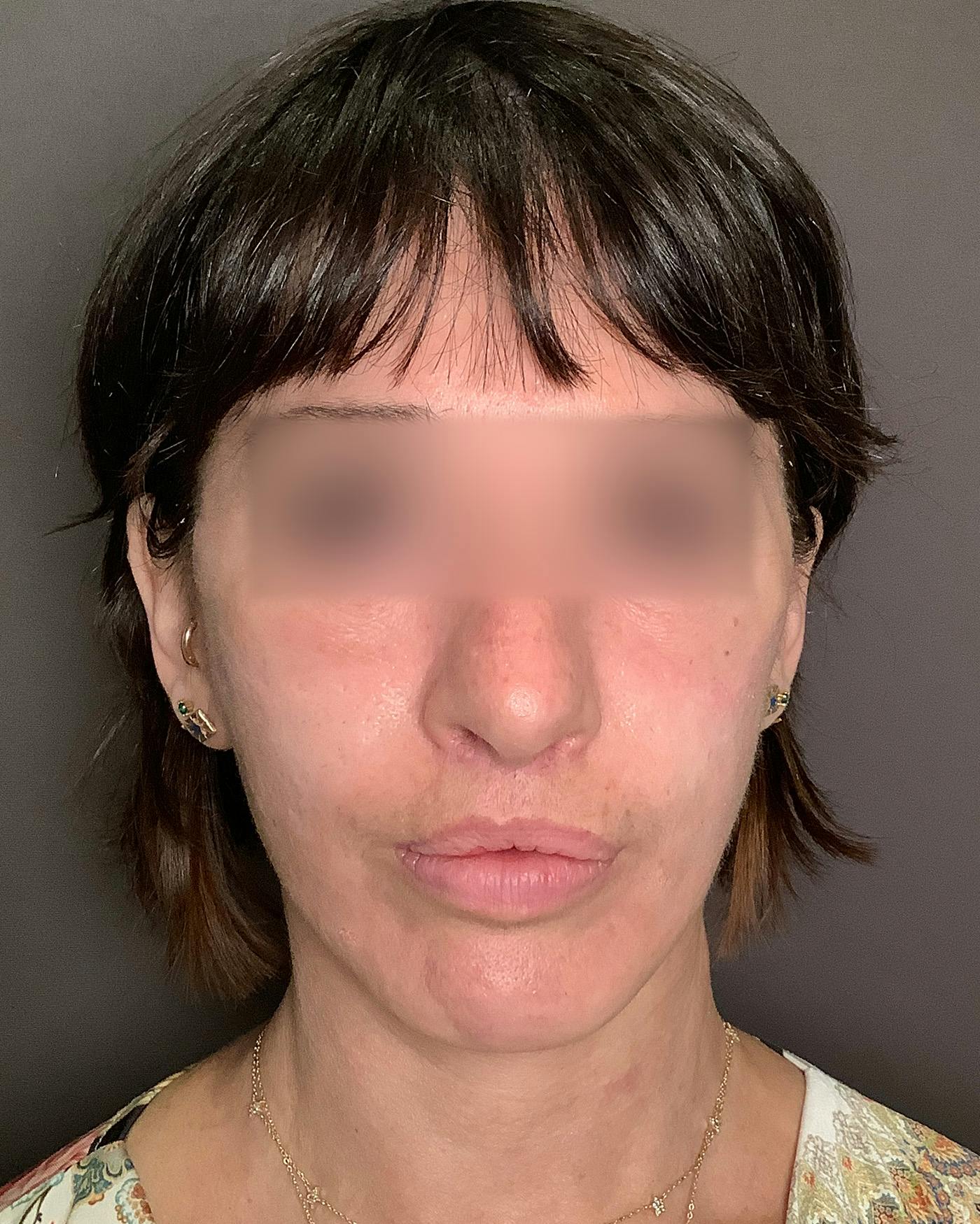 Facelifts / Necklift Before & After Gallery - Patient 842301 - Image 4