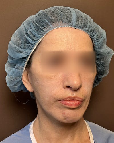 Facelifts / Necklift Before & After Gallery - Patient 842301 - Image 1