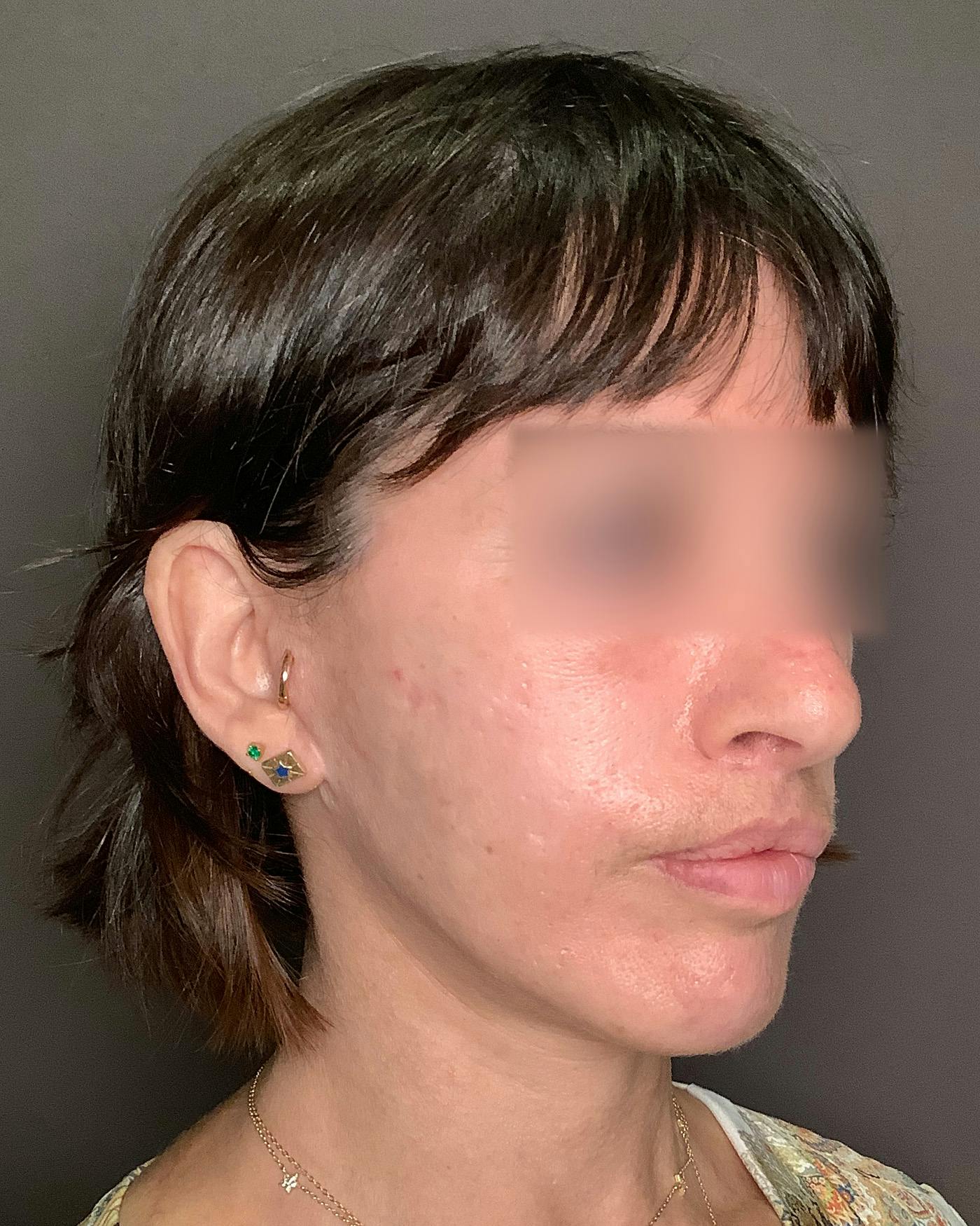 Facelifts / Necklift Before & After Gallery - Patient 842301 - Image 2
