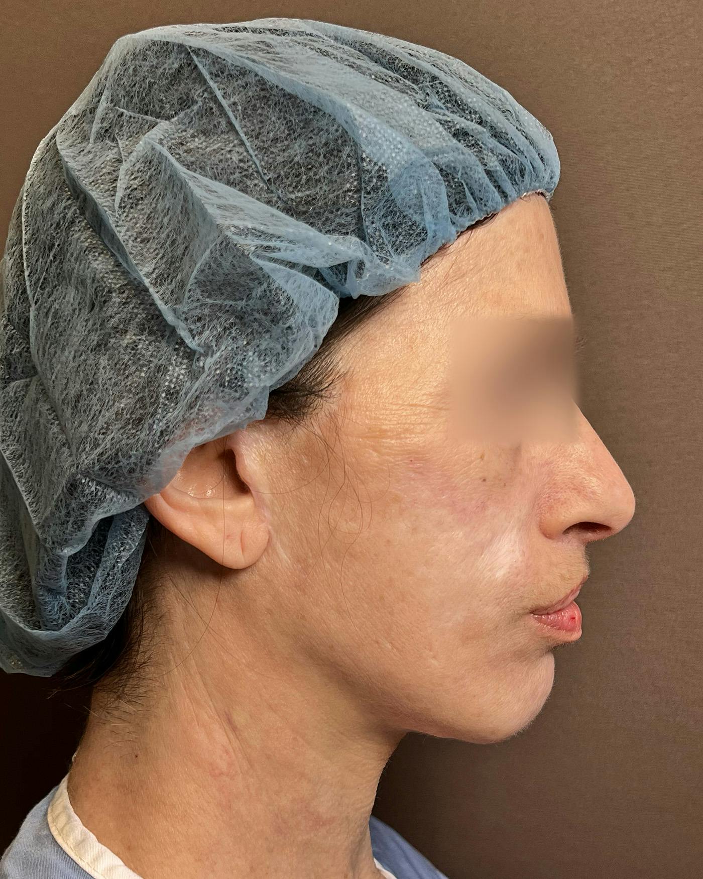 Facelifts / Necklift Before & After Gallery - Patient 842301 - Image 5