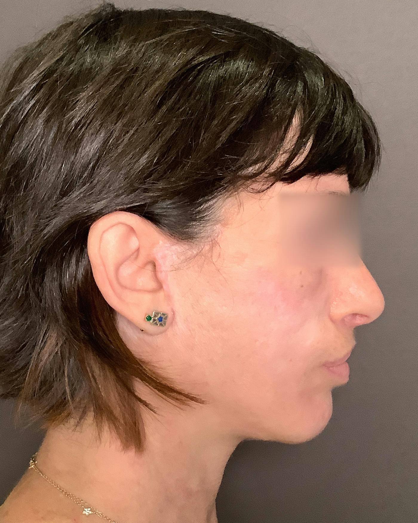 Facelifts / Necklift Before & After Gallery - Patient 842301 - Image 6