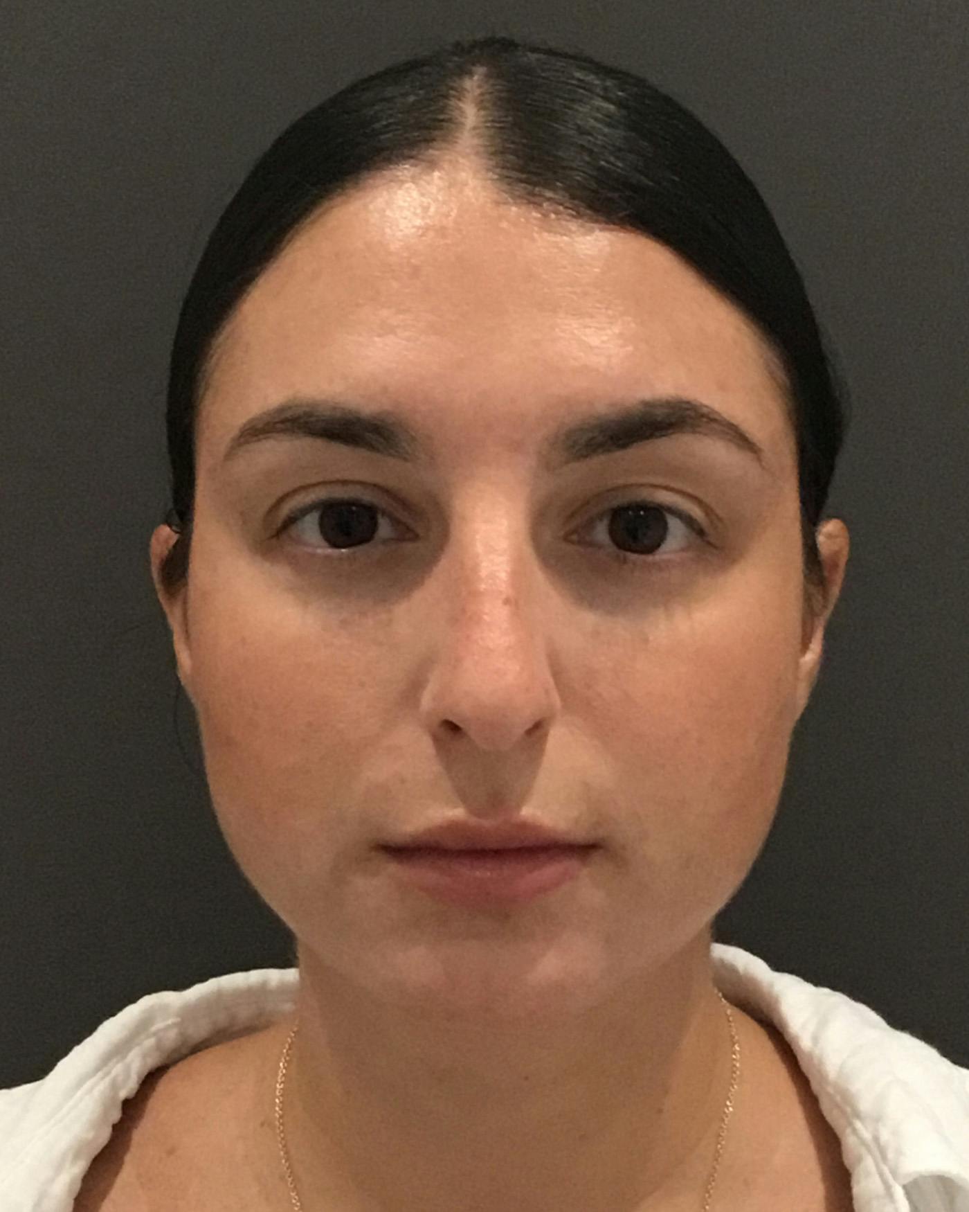 Rhinoplasty Before & After Gallery - Patient 398006 - Image 5