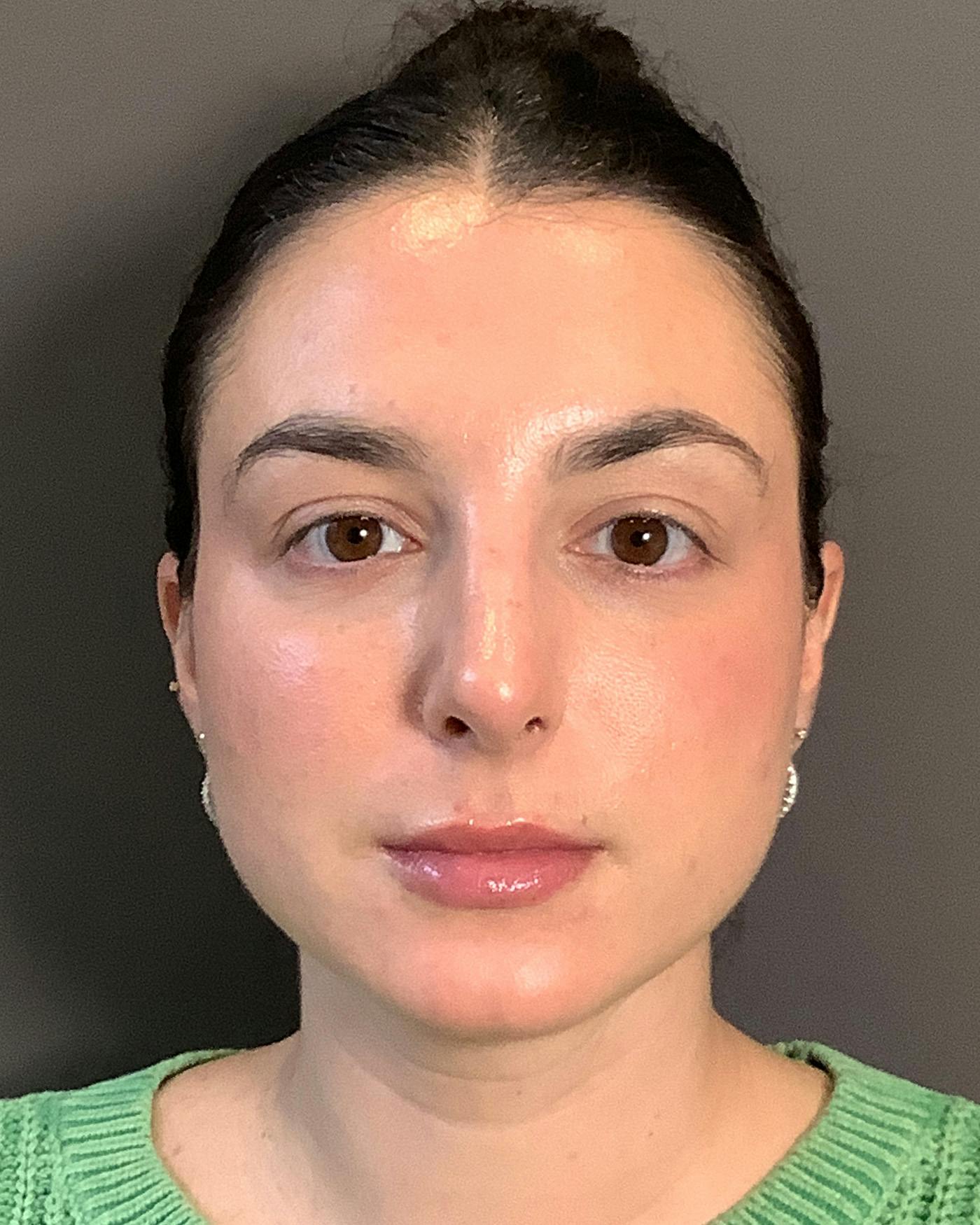 Rhinoplasty Before & After Gallery - Patient 398006 - Image 6