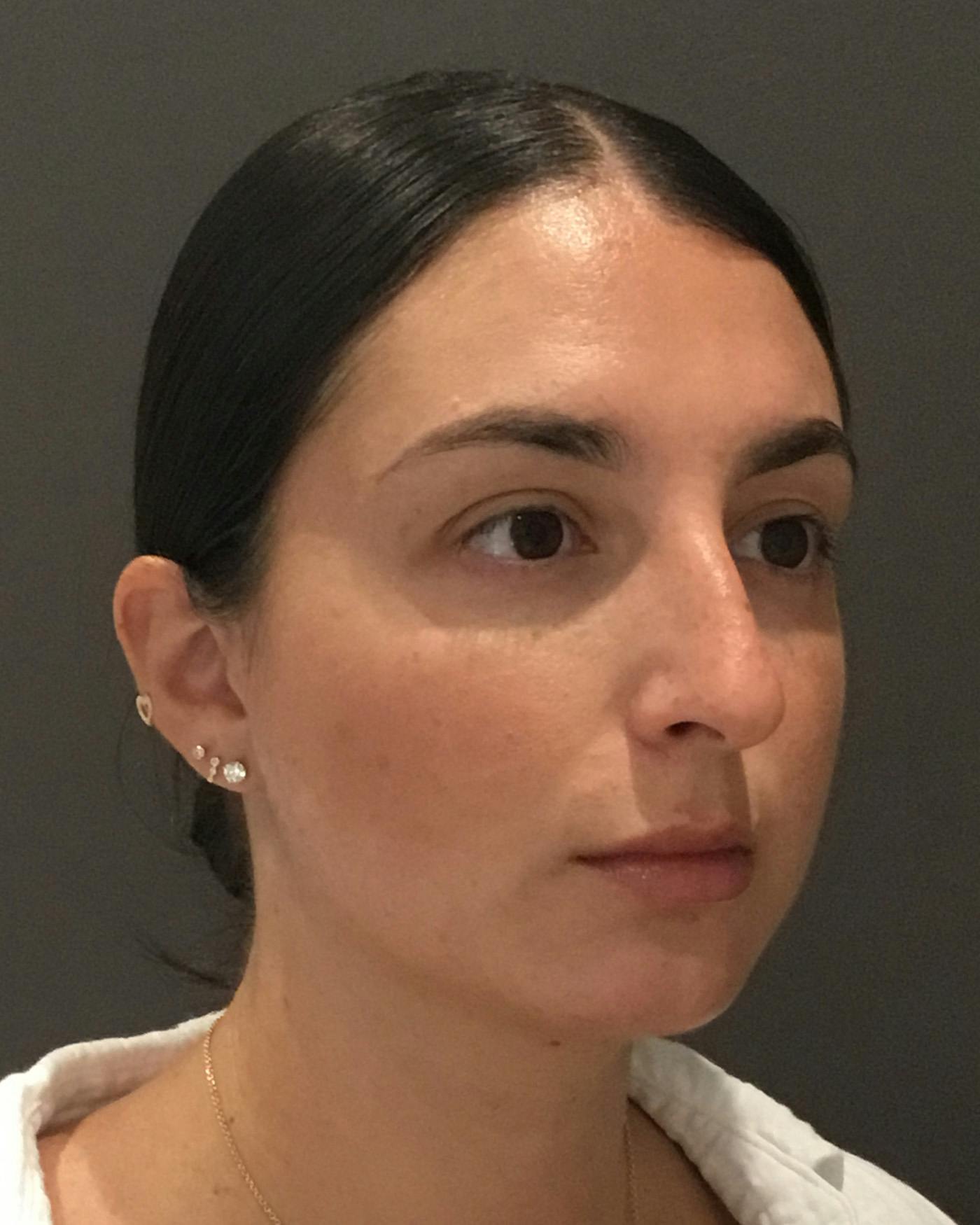 Rhinoplasty Before & After Gallery - Patient 398006 - Image 3
