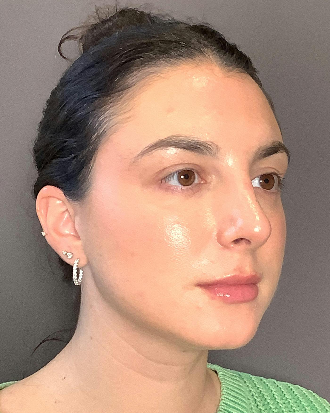 Rhinoplasty Before & After Gallery - Patient 398006 - Image 4