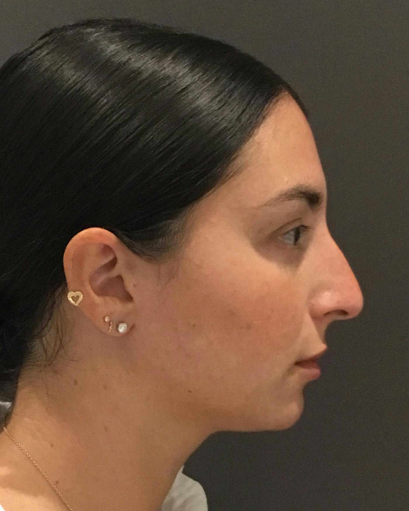 Rhinoplasty Before & After Gallery - Patient 398006 - Image 1