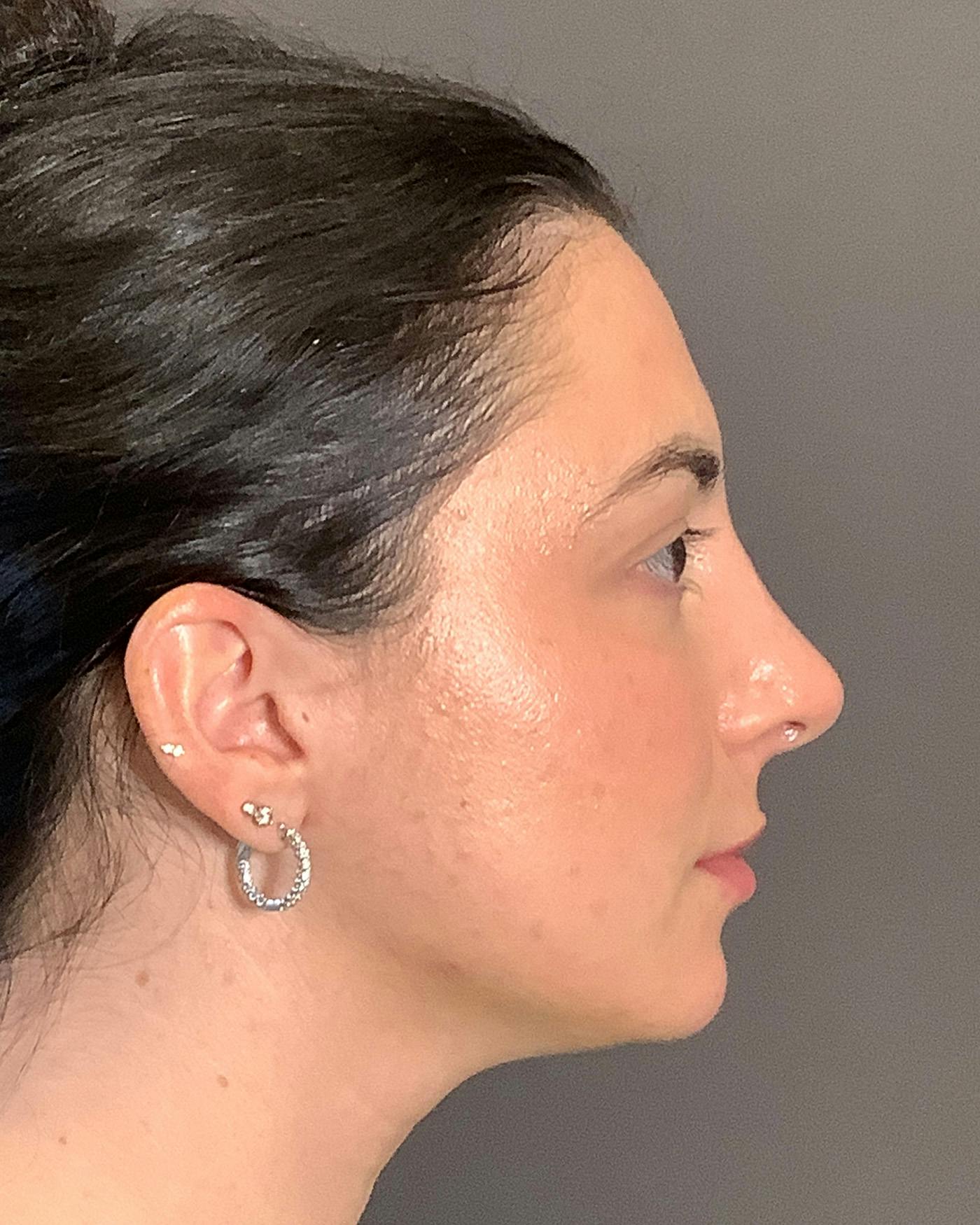 Rhinoplasty Before & After Gallery - Patient 398006 - Image 2