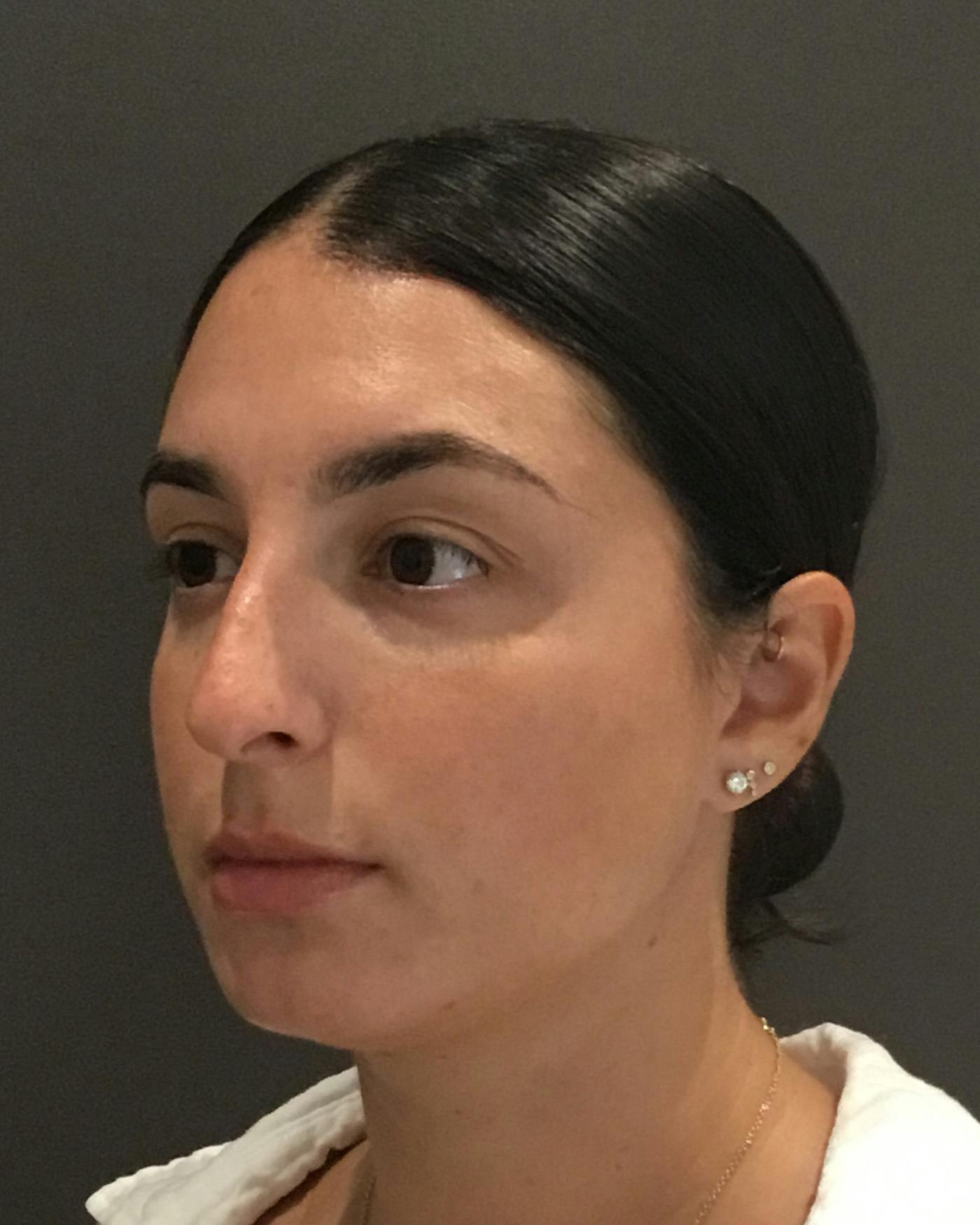 Rhinoplasty Before & After Gallery - Patient 398006 - Image 7
