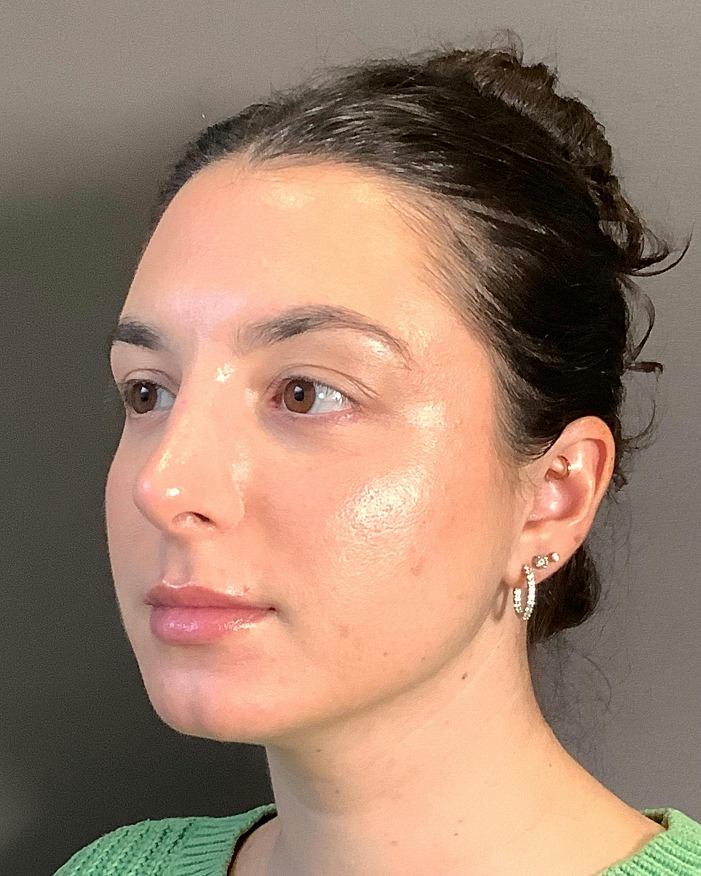 Rhinoplasty Before & After Gallery - Patient 398006 - Image 8