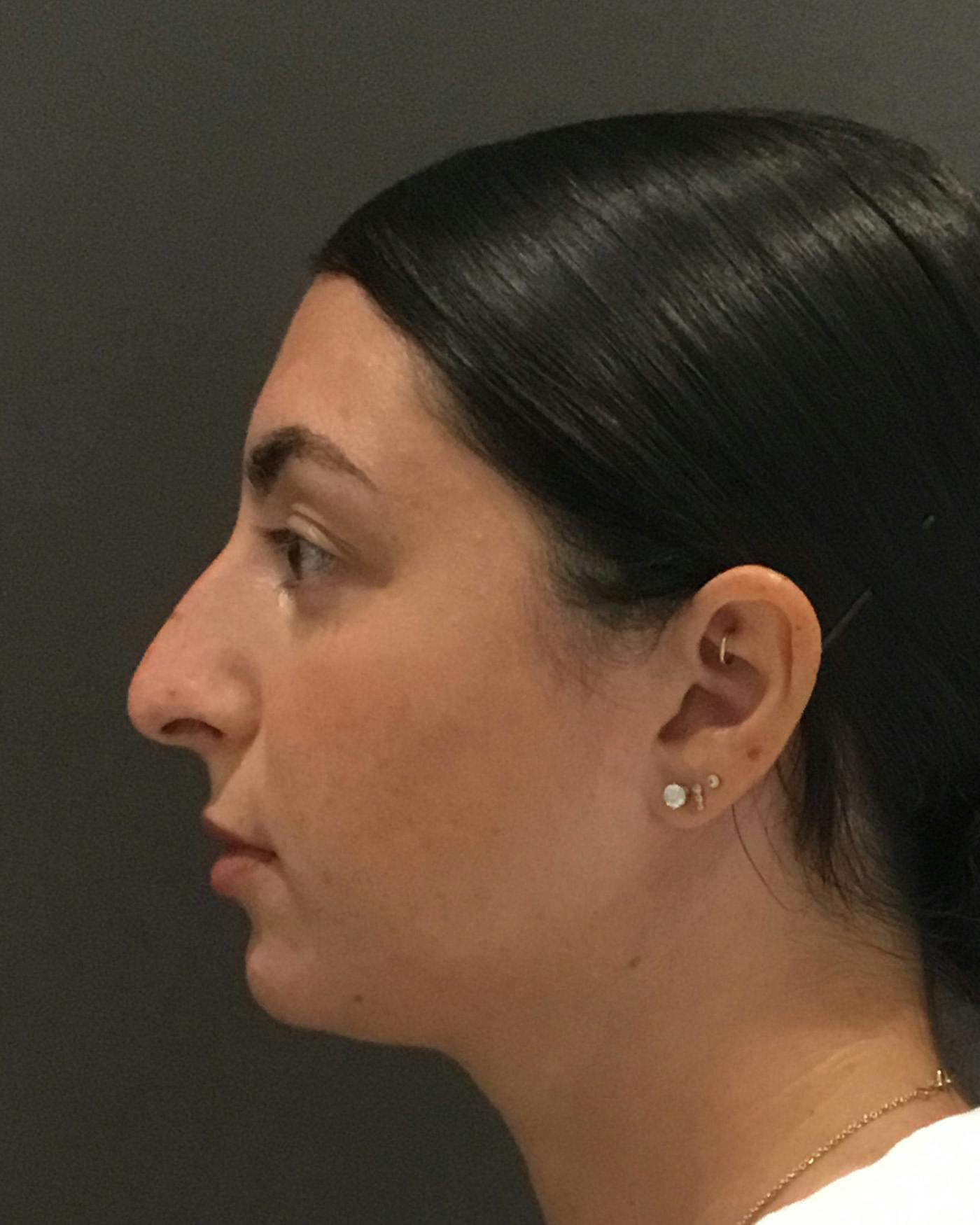 Rhinoplasty Before & After Gallery - Patient 398006 - Image 9