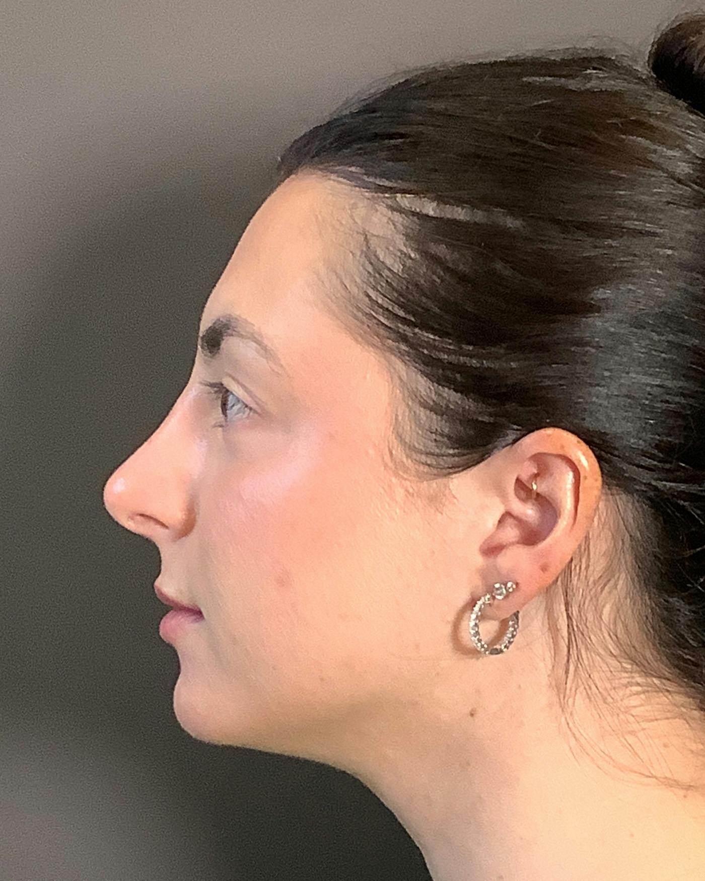Rhinoplasty Before & After Gallery - Patient 398006 - Image 10