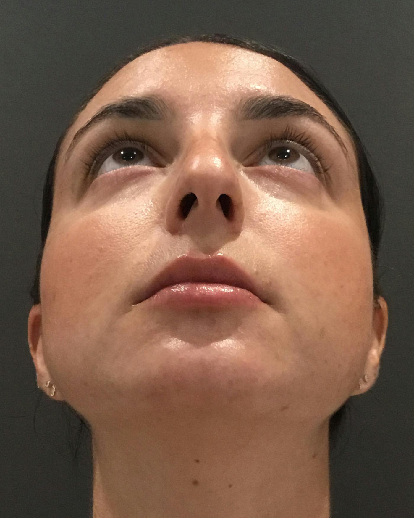 Rhinoplasty Before & After Gallery - Patient 398006 - Image 11