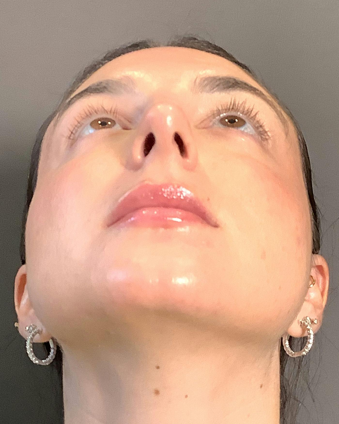 Rhinoplasty Before & After Gallery - Patient 398006 - Image 12