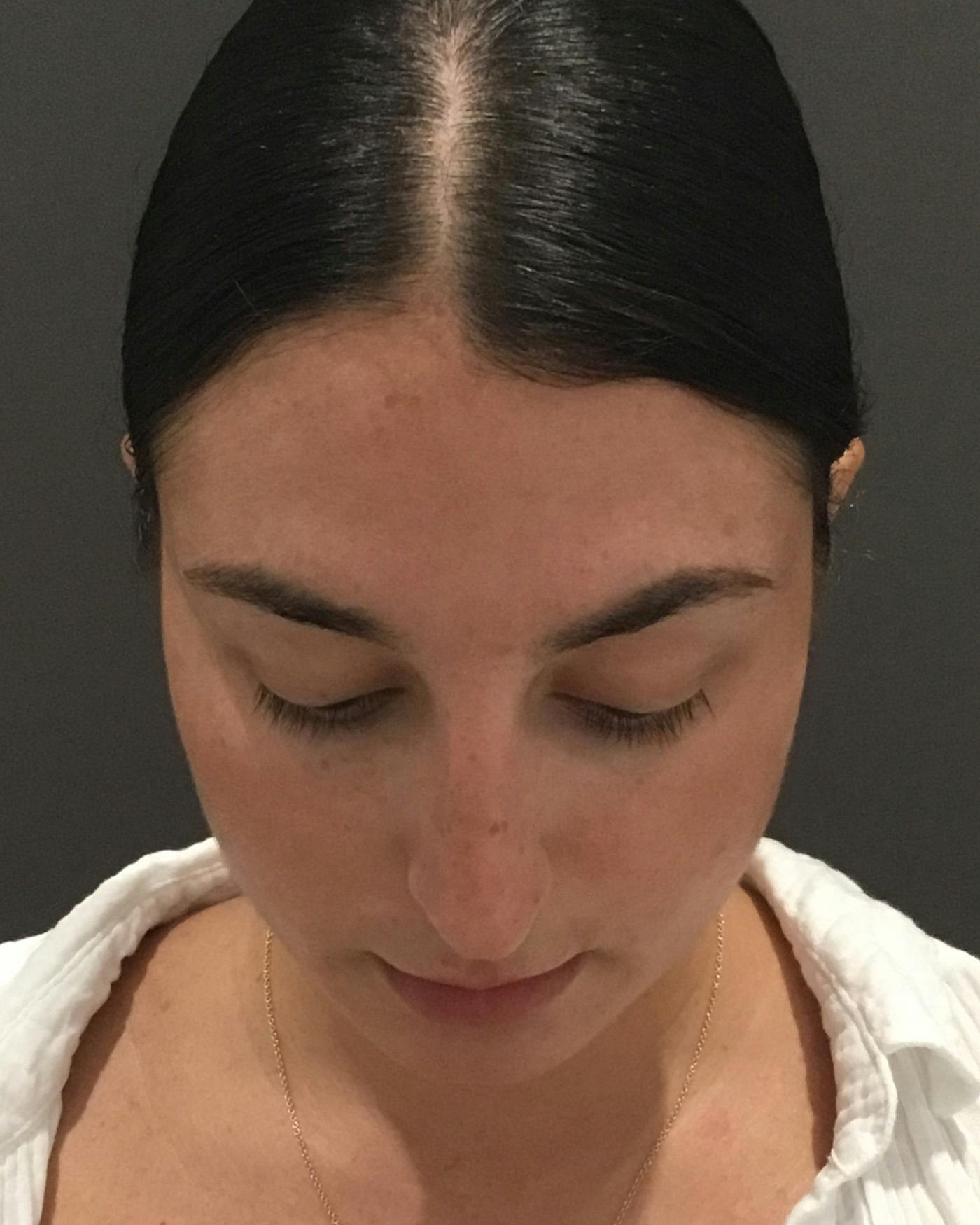 Rhinoplasty Before & After Gallery - Patient 398006 - Image 13