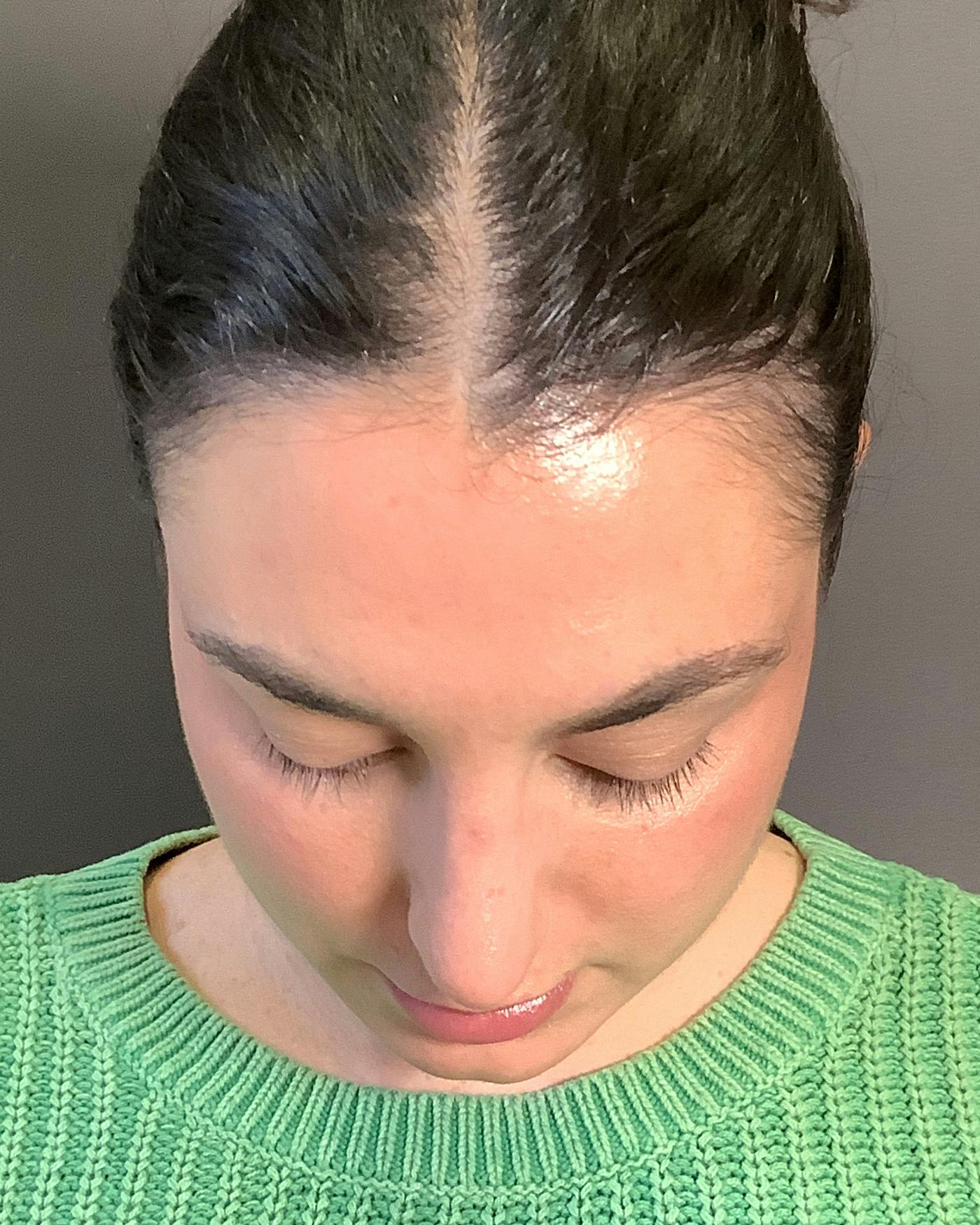Rhinoplasty Before & After Gallery - Patient 398006 - Image 14