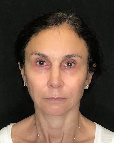 Facial Fat Transfer Before & After Gallery - Patient 340464 - Image 1