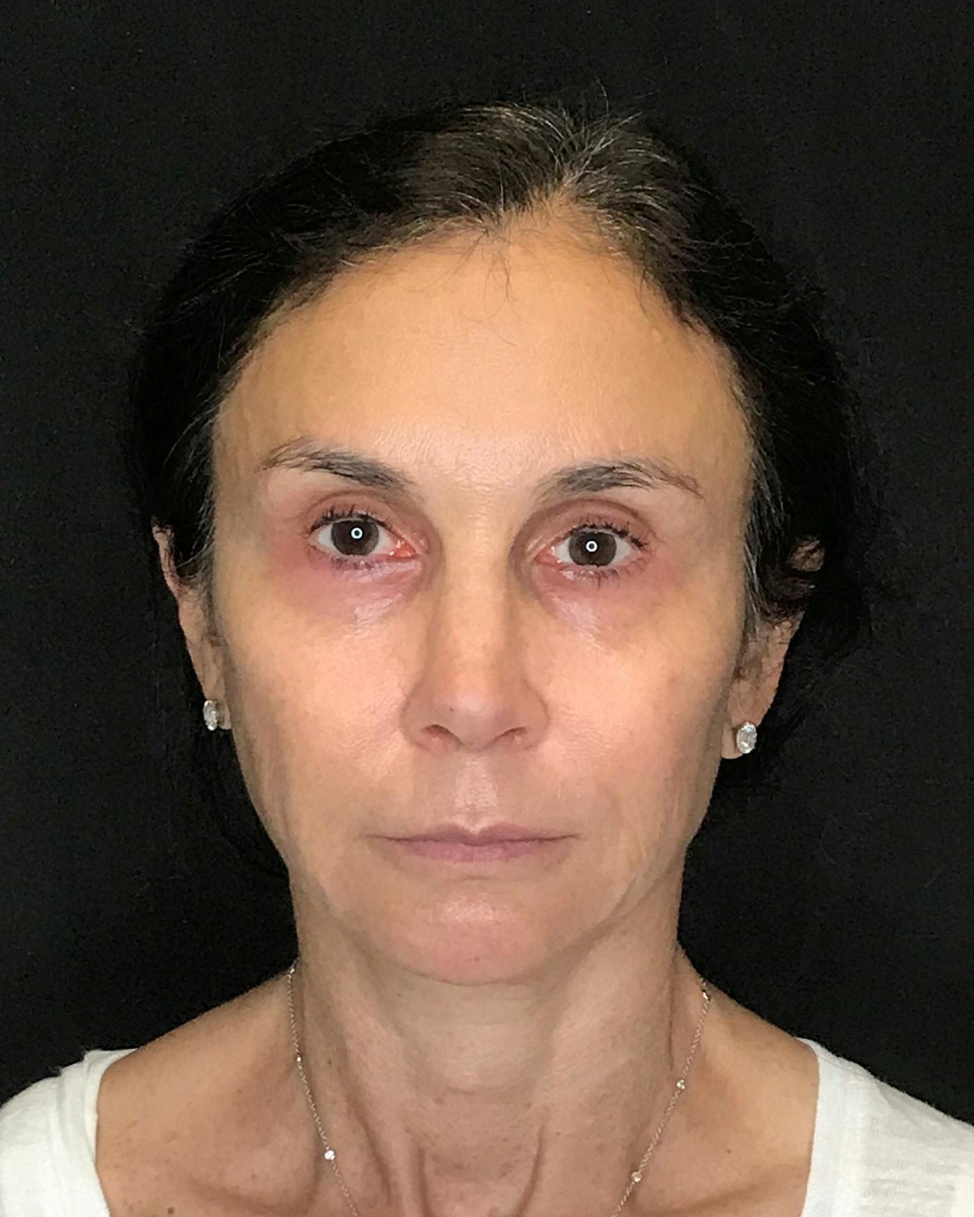 Facelifts / Necklift Before & After Gallery - Patient 415604 - Image 3