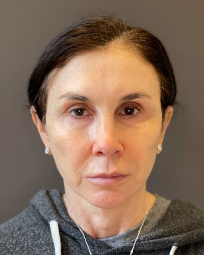 Facial Fat Transfer Before & After Gallery - Patient 340464 - Image 2