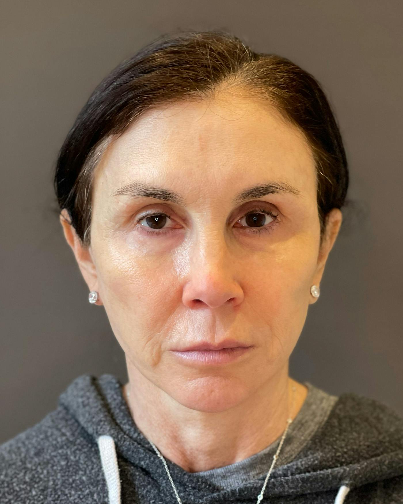 Facelifts / Necklift Before & After Gallery - Patient 415604 - Image 4