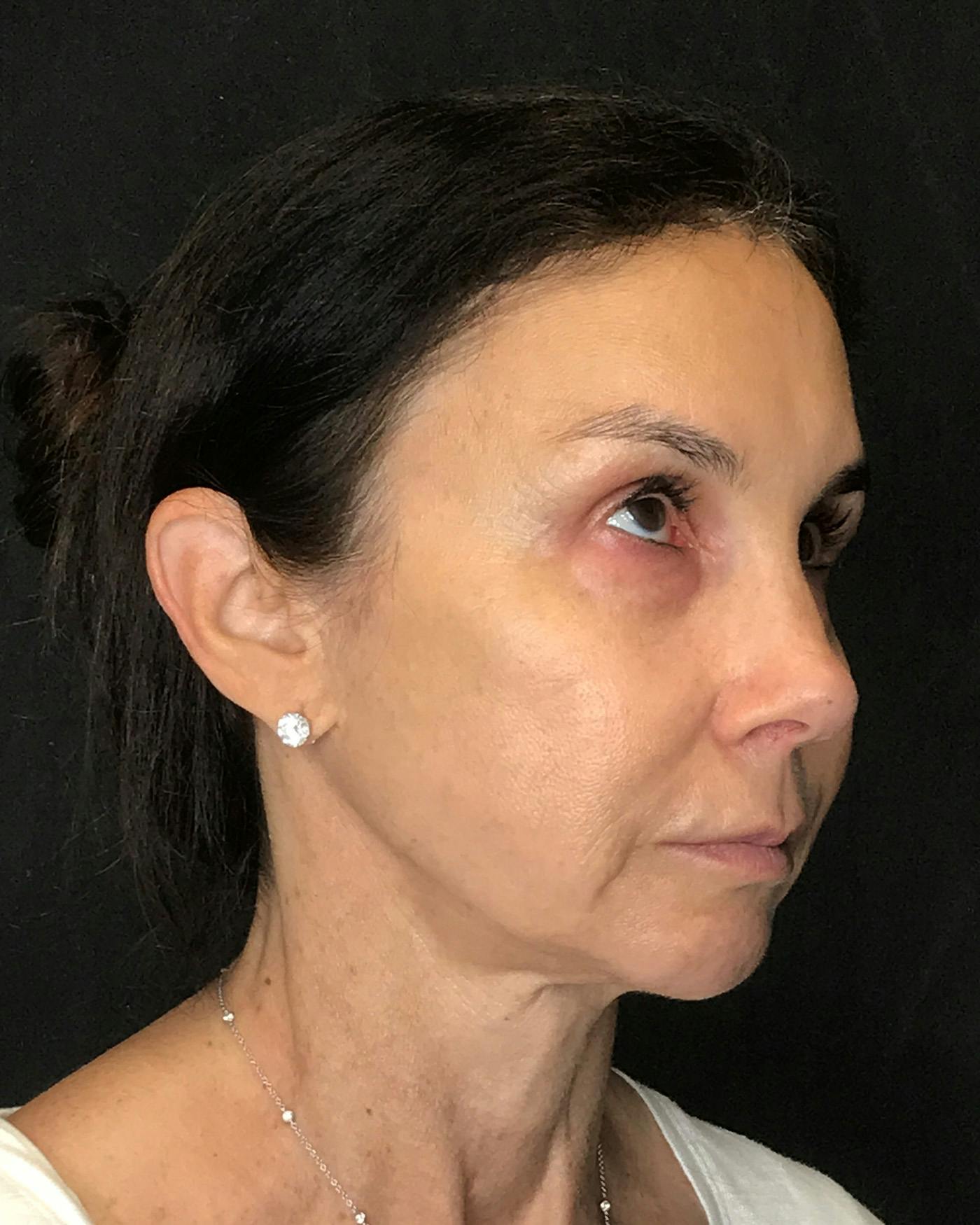 Facelifts / Necklift Before & After Gallery - Patient 415604 - Image 1