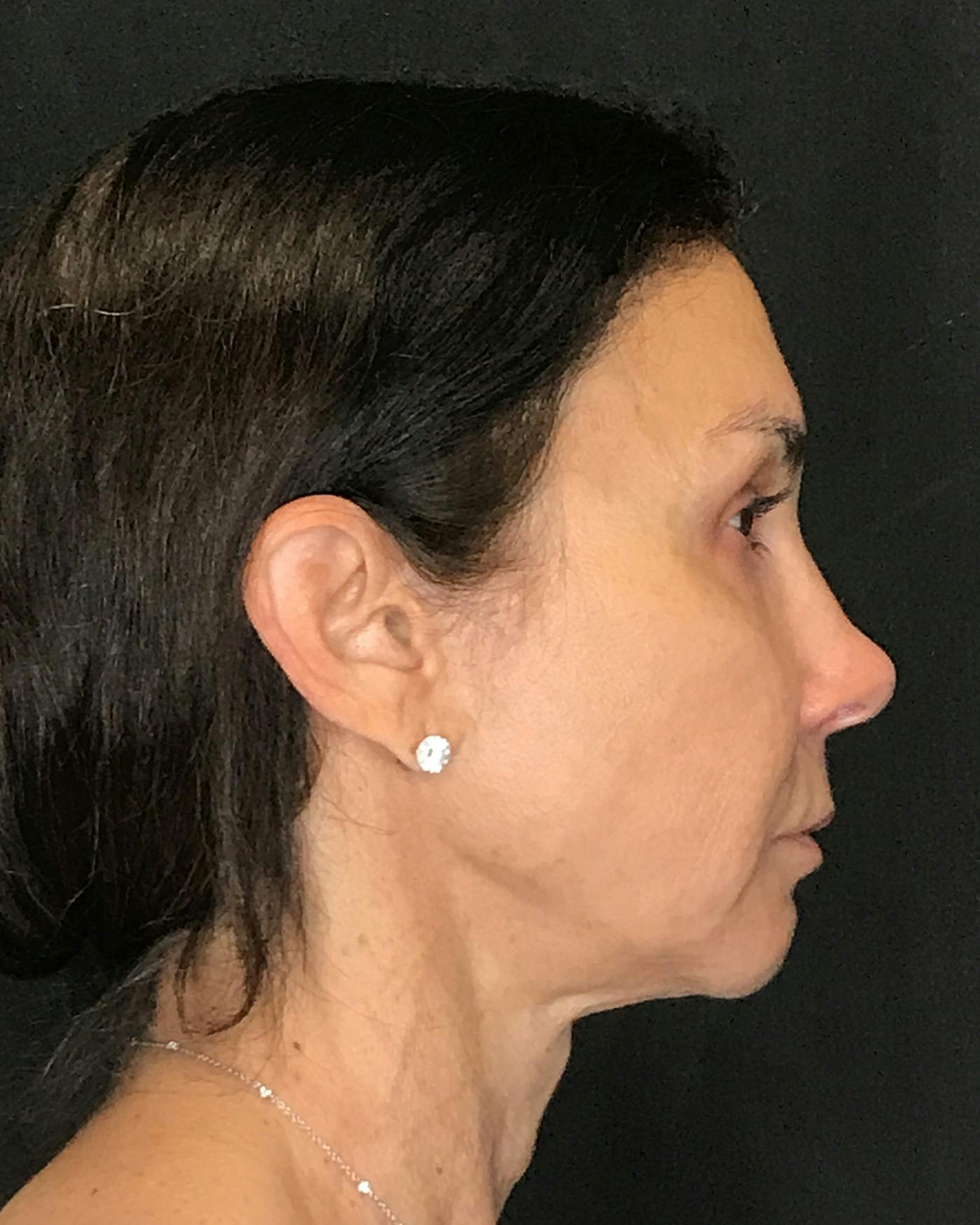 Facelifts / Necklift Before & After Gallery - Patient 415604 - Image 7