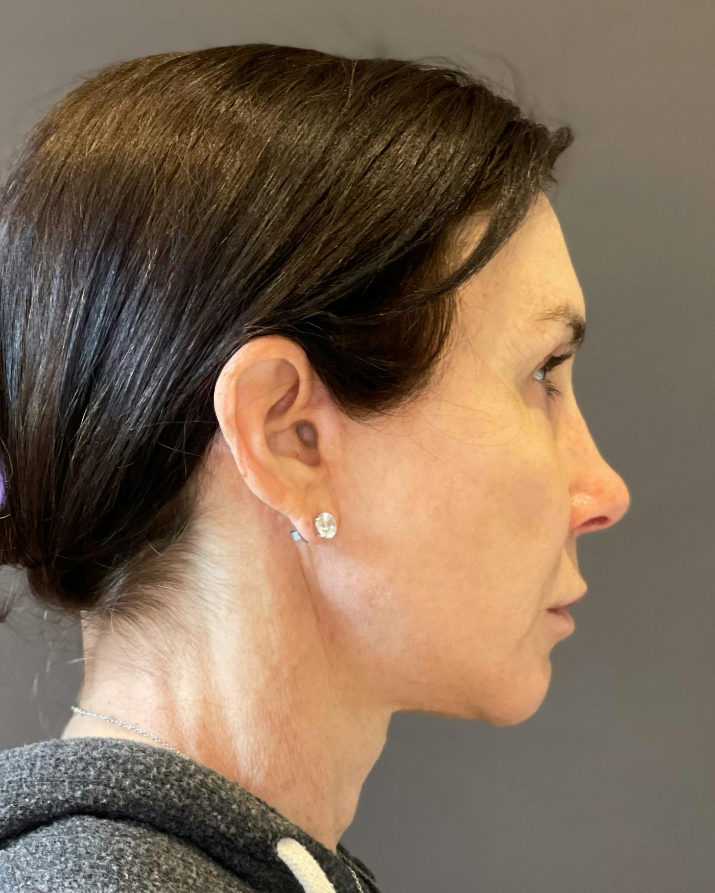 Facelifts / Necklift Before & After Gallery - Patient 415604 - Image 8