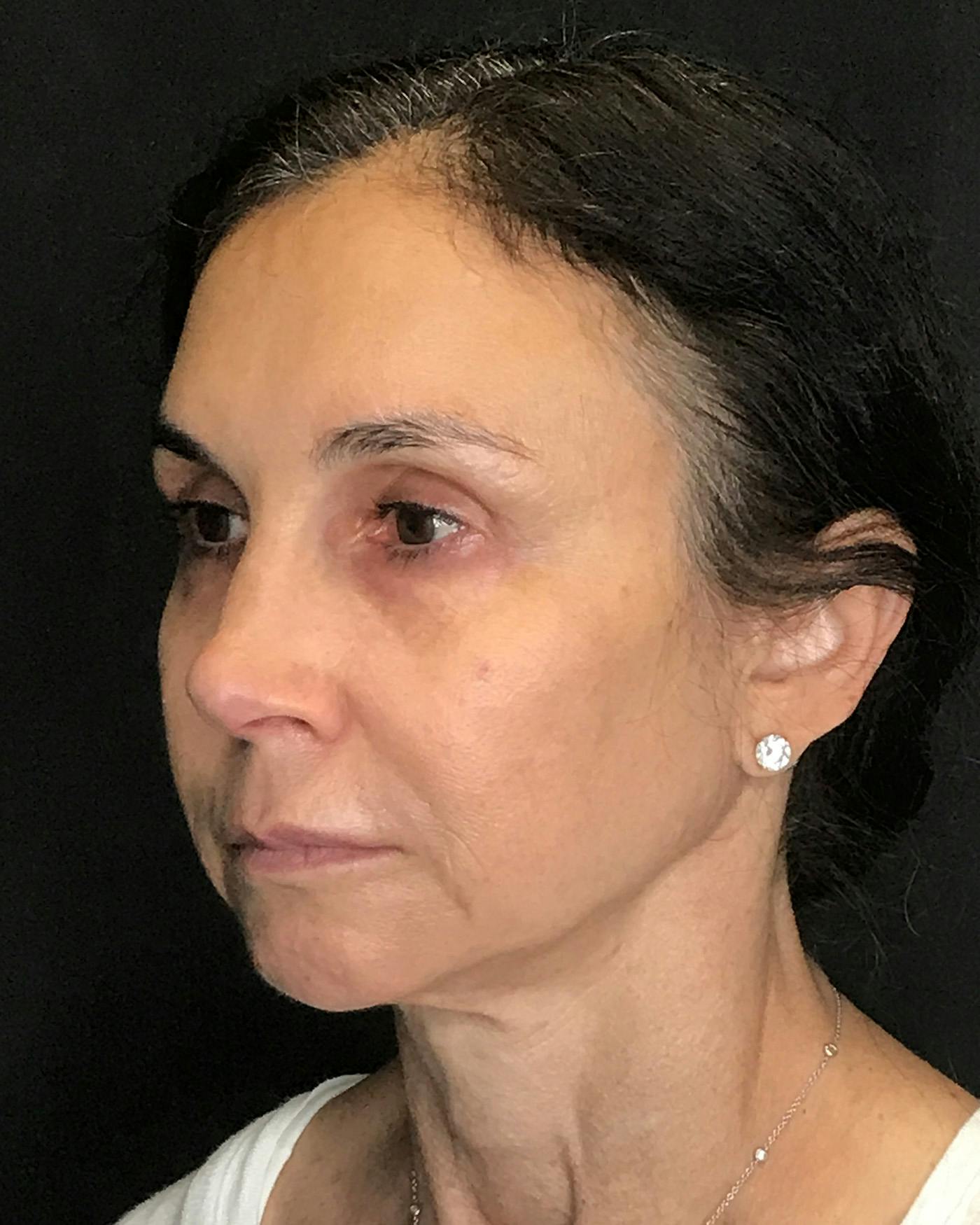 Facelifts / Necklift Before & After Gallery - Patient 415604 - Image 5