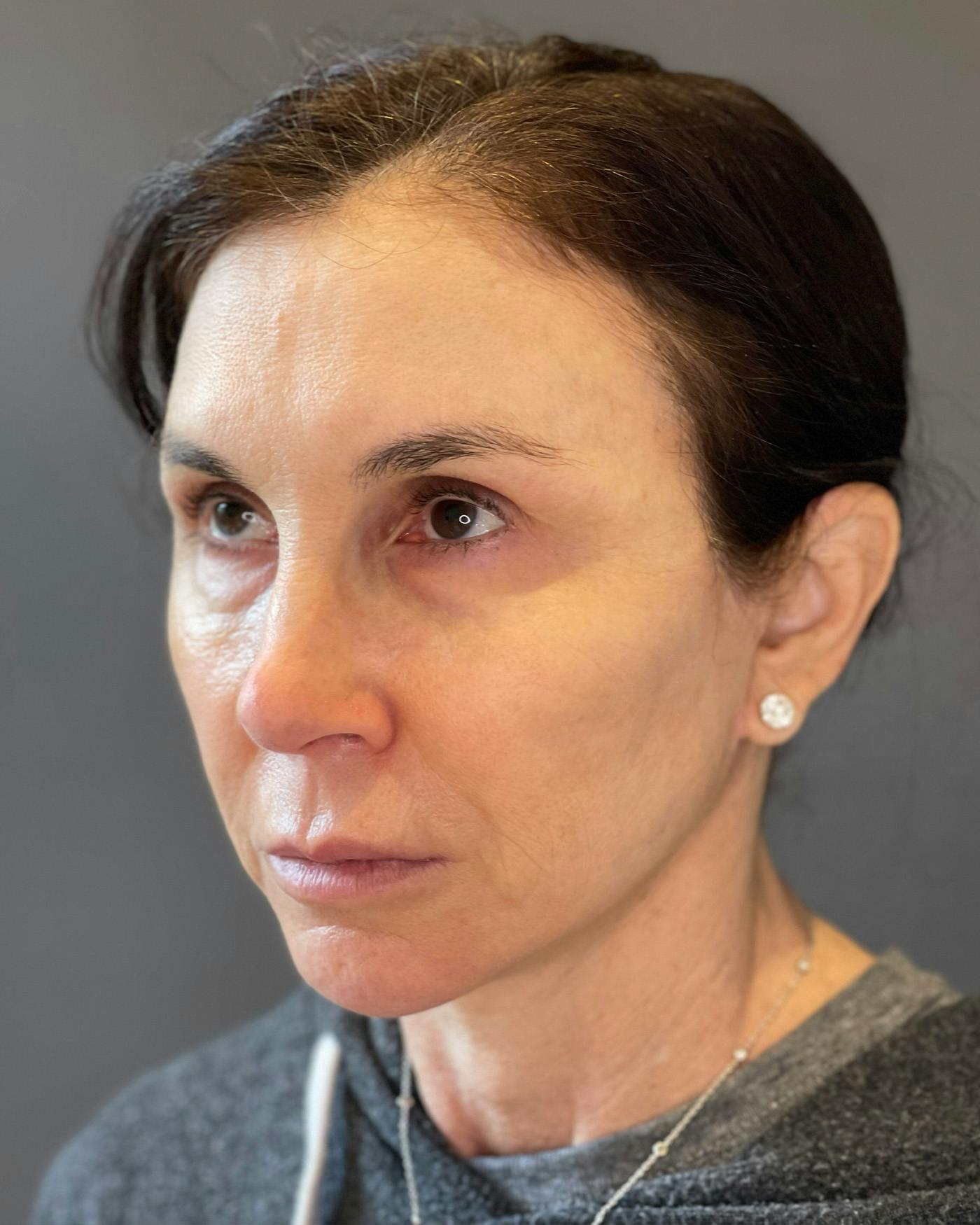 Facelifts / Necklift Before & After Gallery - Patient 415604 - Image 6