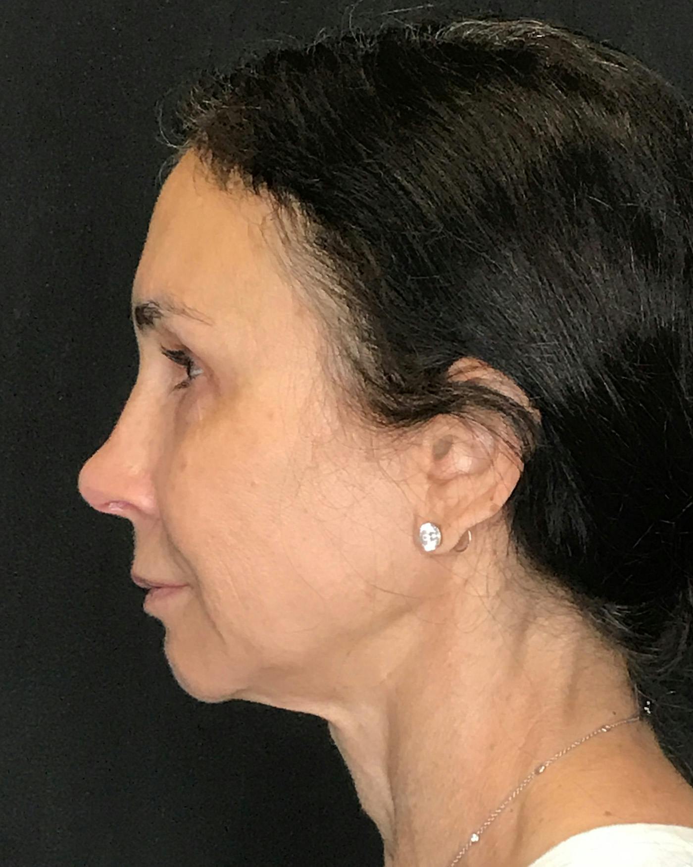 Facelifts / Necklift Before & After Gallery - Patient 415604 - Image 9