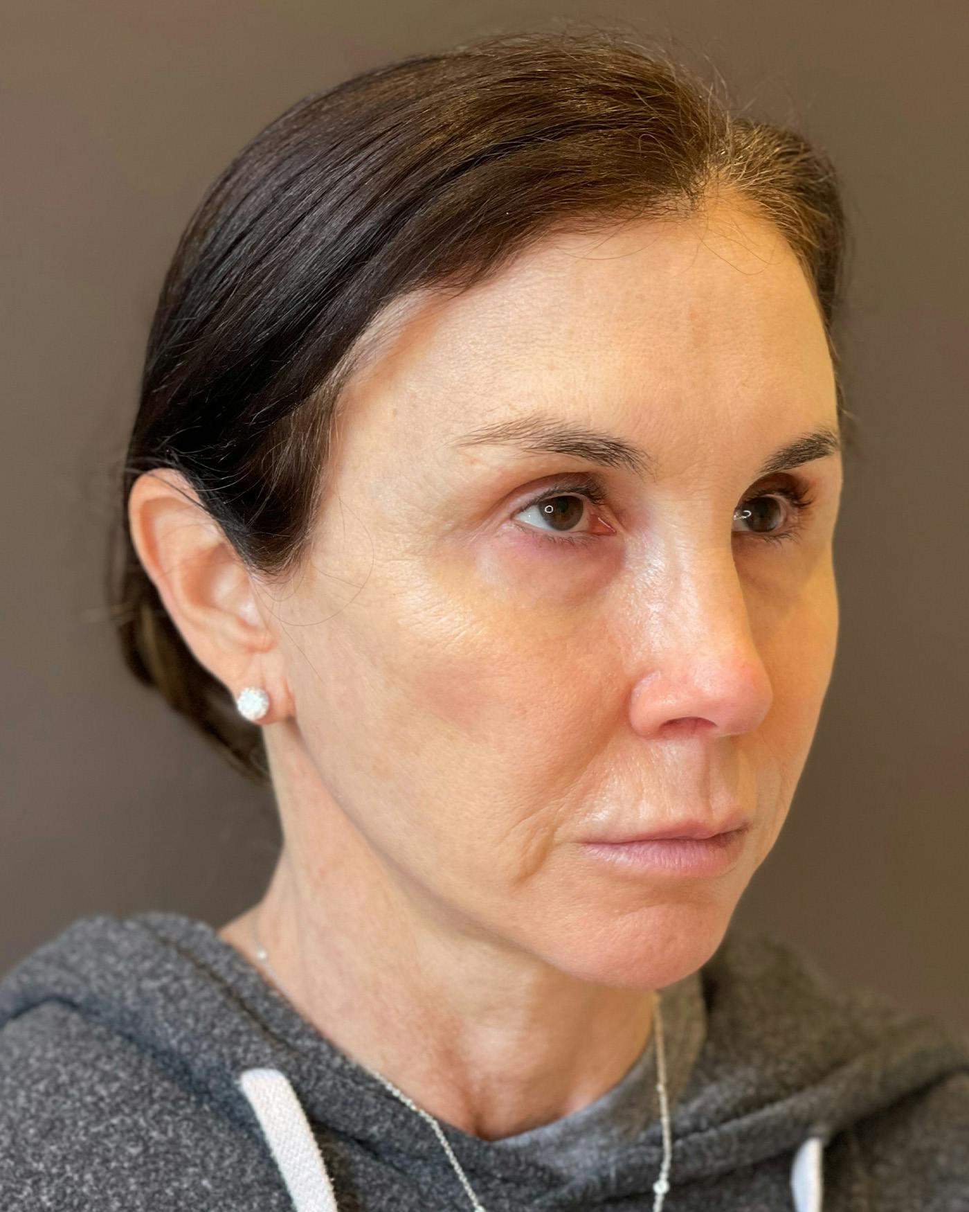 Facelifts / Necklift Before & After Gallery - Patient 415604 - Image 2