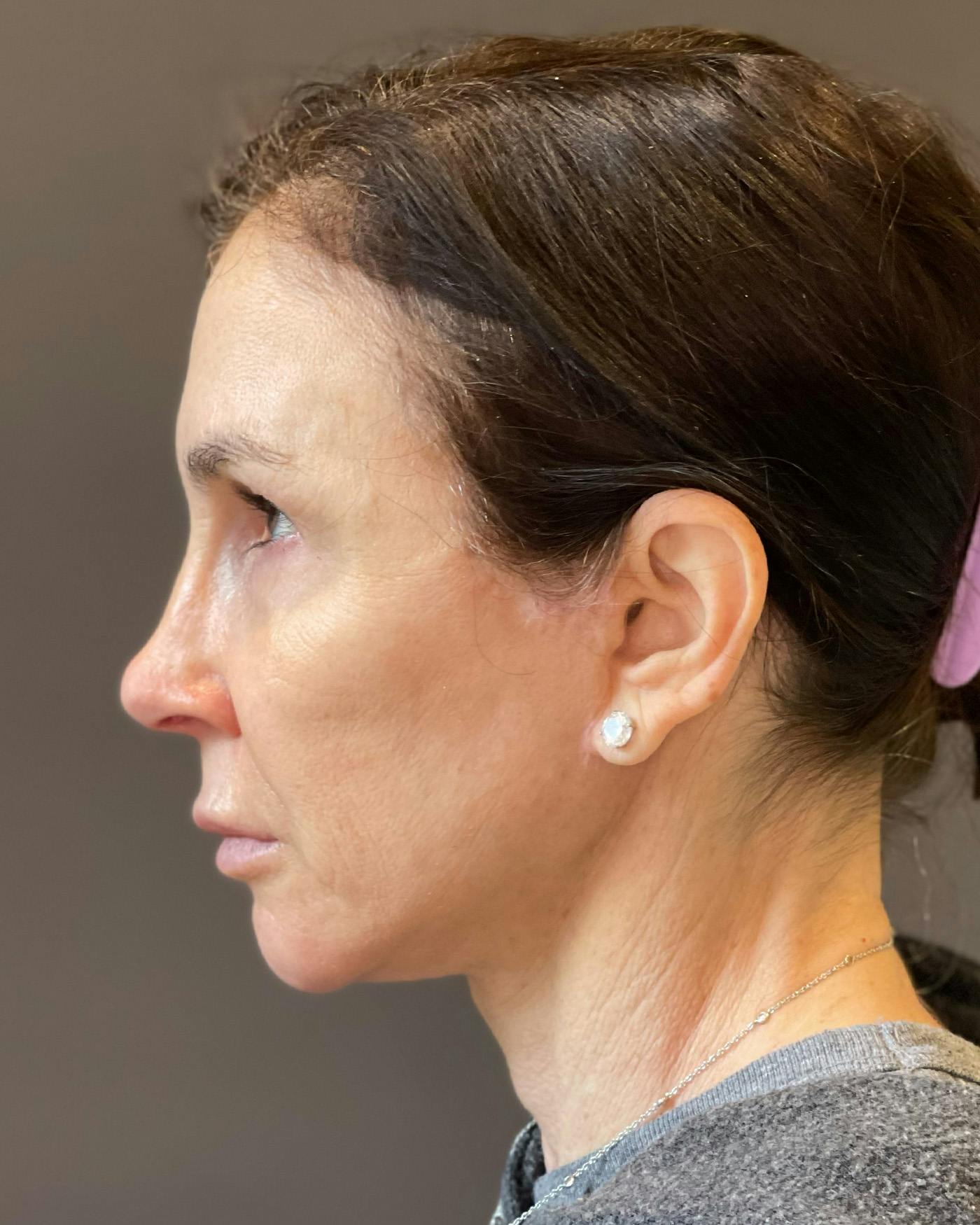 Facelifts / Necklift Before & After Gallery - Patient 415604 - Image 10