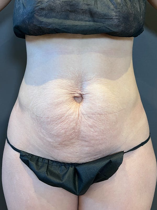 Tummy Tuck Before & After Gallery - Patient 363352 - Image 1