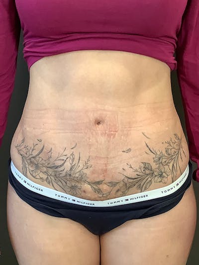 Tummy Tuck Before & After Gallery - Patient 363352 - Image 2