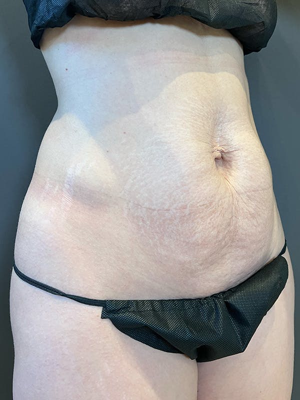Tummy Tuck Before & After Gallery - Patient 363352 - Image 3