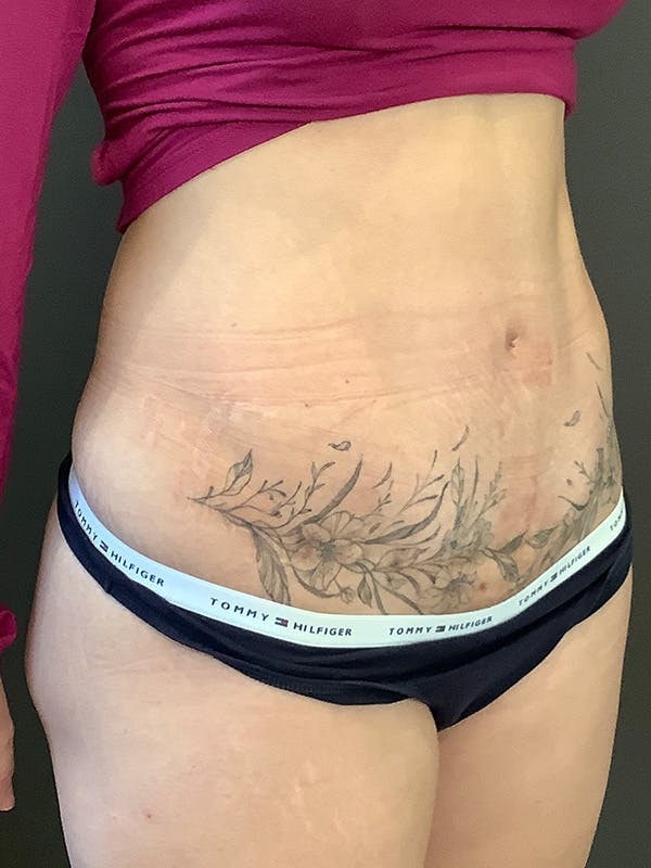 Tummy Tuck Before & After Gallery - Patient 363352 - Image 4
