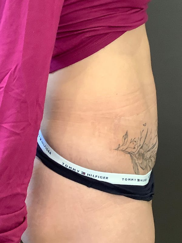 Tummy Tuck Before & After Gallery - Patient 363352 - Image 6