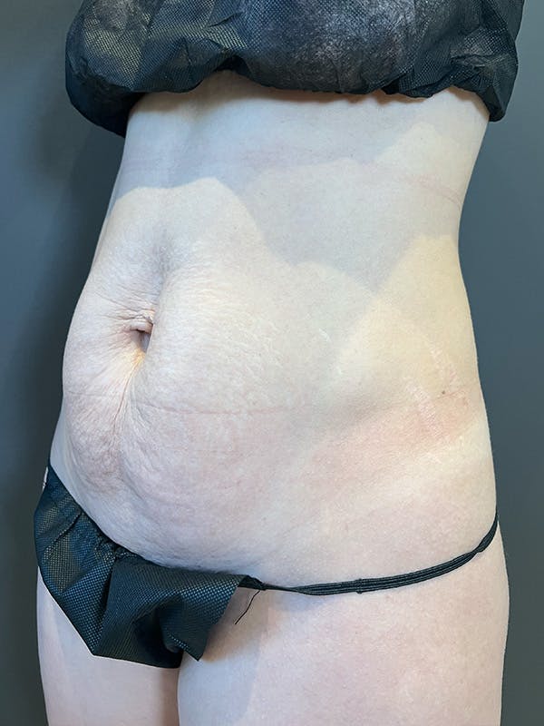 Tummy Tuck Before & After Gallery - Patient 363352 - Image 7
