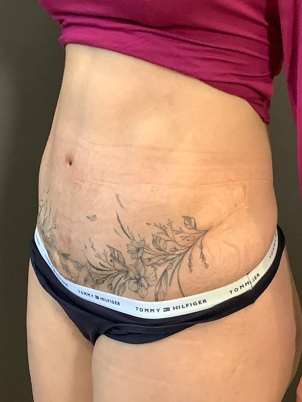 Tummy Tuck Before & After Gallery - Patient 363352 - Image 8