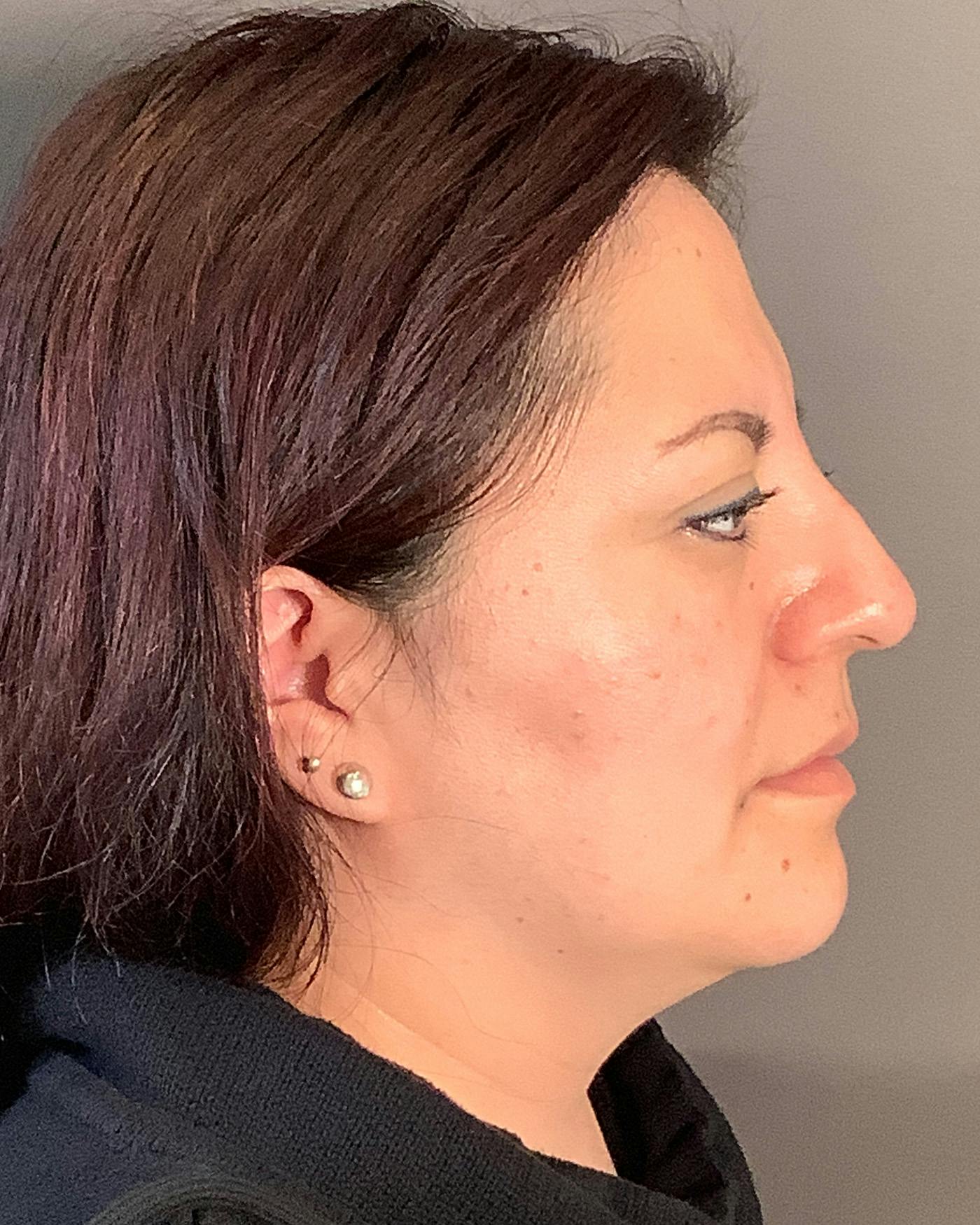 Liposuction Before & After Gallery - Patient 115675 - Image 9