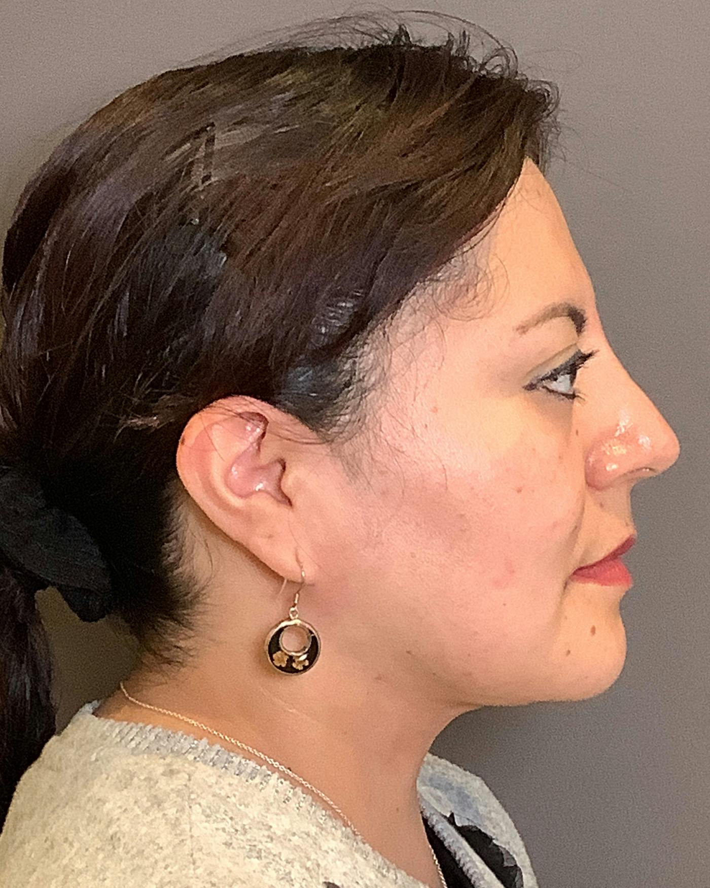 Liposuction Before & After Gallery - Patient 115675 - Image 10