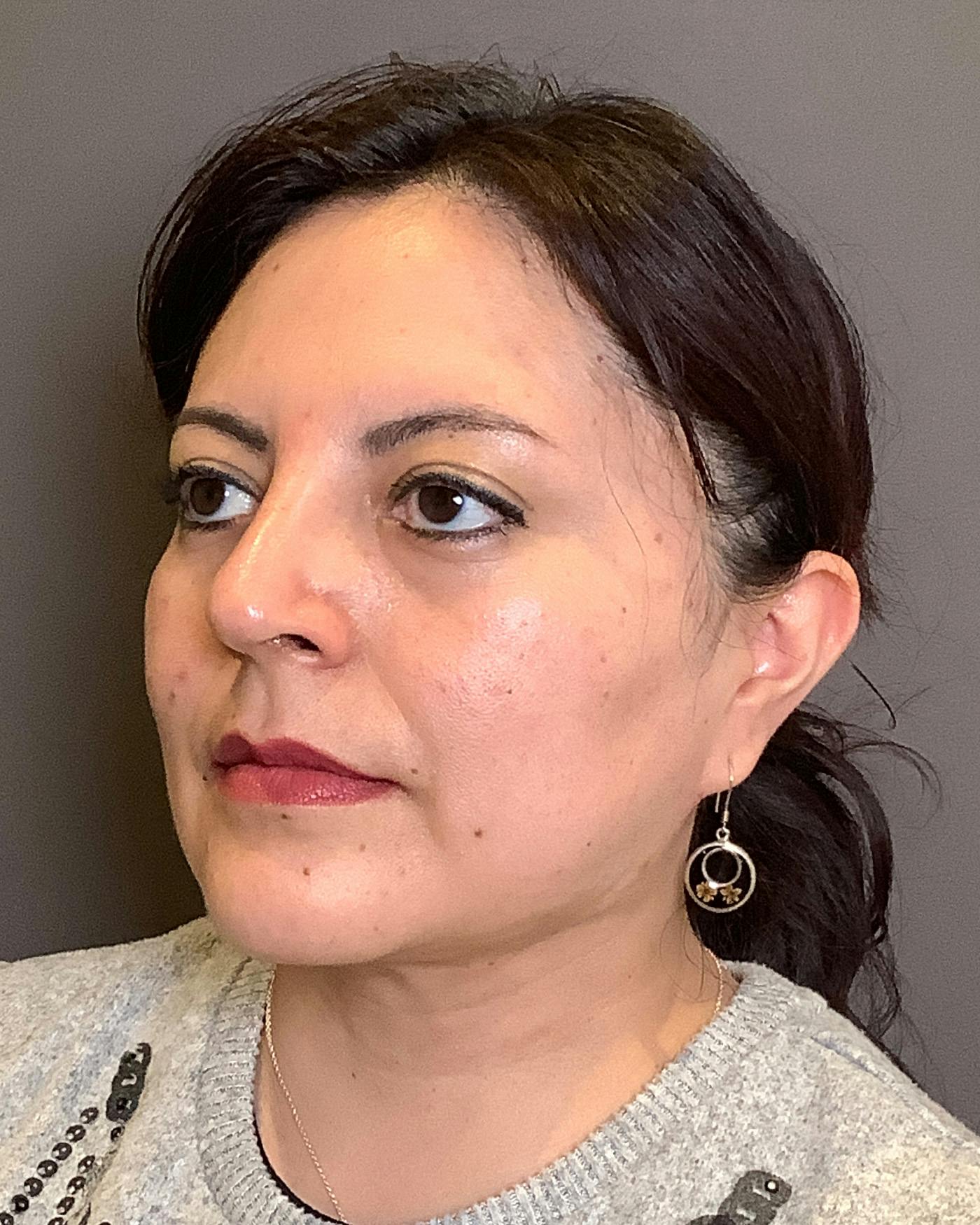 Liposuction Before & After Gallery - Patient 115675 - Image 6