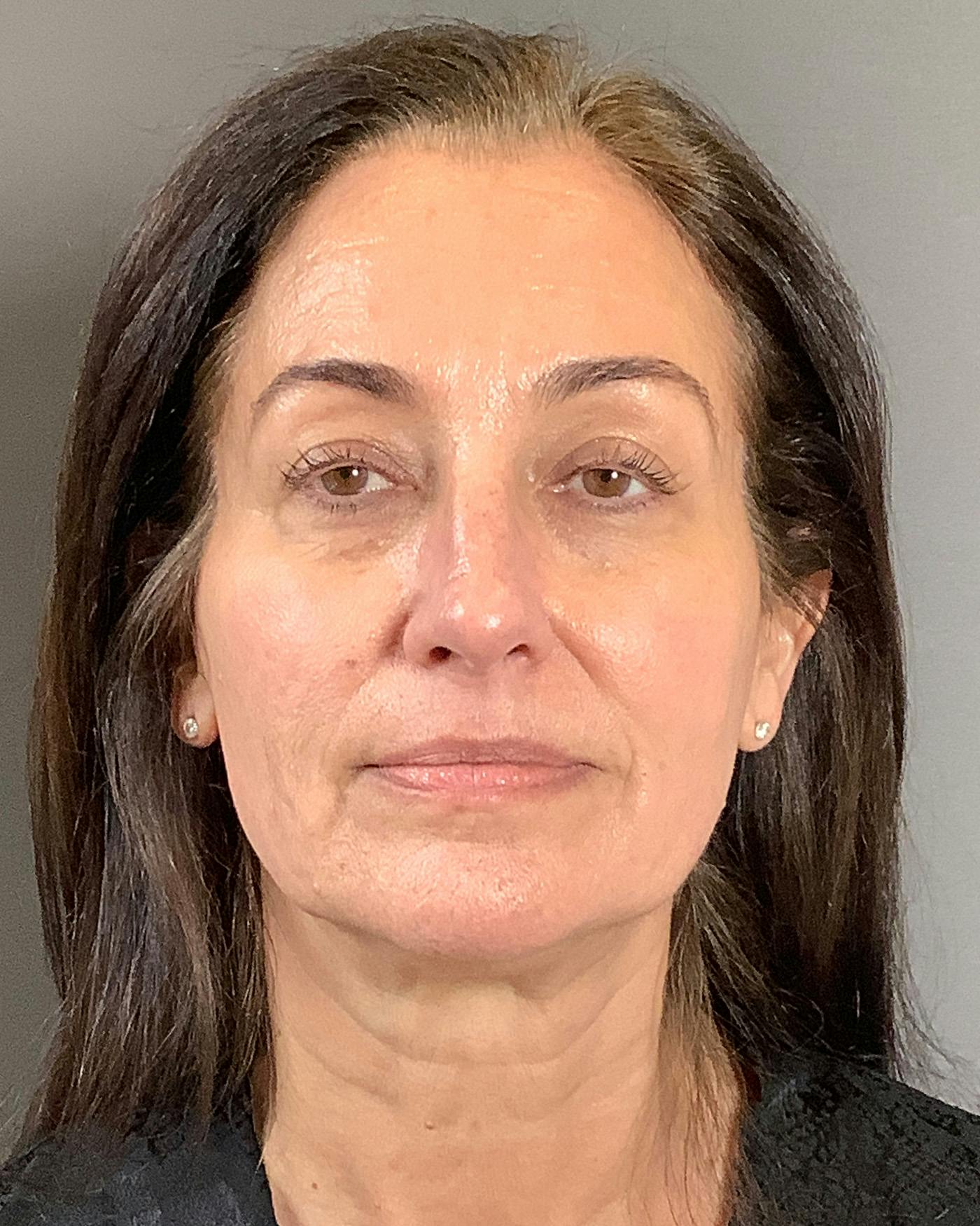 Facelifts / Necklift Before & After Gallery - Patient 163098 - Image 5
